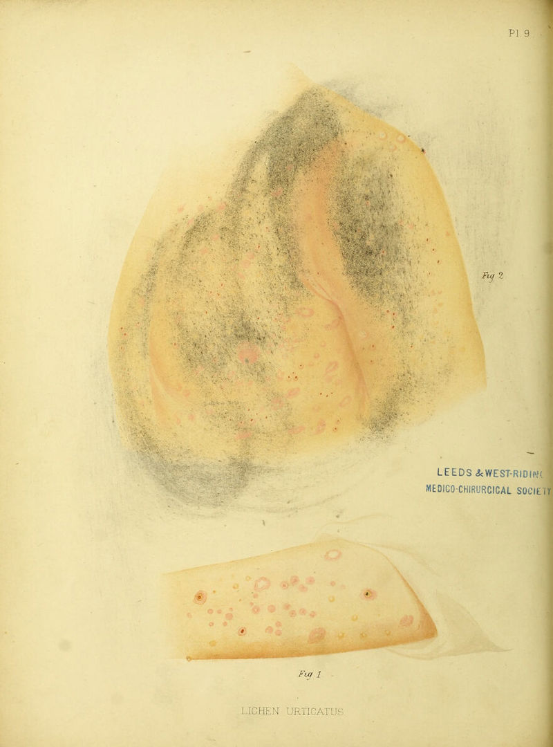 LEEDS <ScWEST-RIDI|v»( MEOICO-CHIRURGICAL SOCIETY « LICHEN URTICATUS