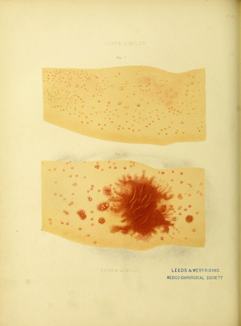 Ay./. LICHEN AQKllJ LEEDS <5<WEST-RIDING MEDICO-CHIRURCICAL SOCIETY