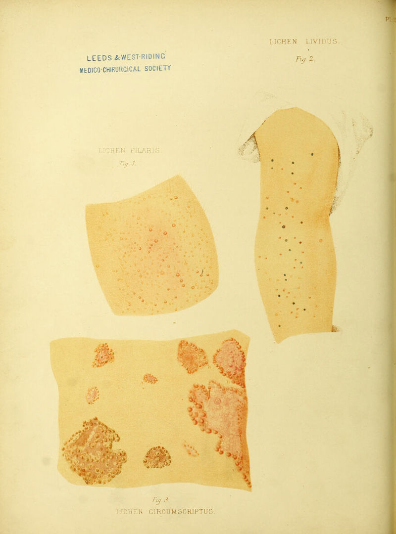 MEDICO-CHIRURGIGAL SOCIETY LICHEN LIVIDUS % Z. Fv^ S LICHEN CIRCUMSCRIPTUS,