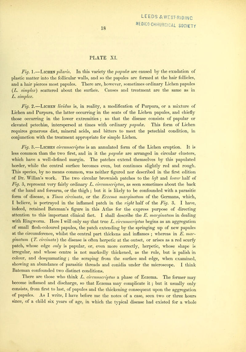 PLATE XL . Fig. 1.—Lichen joz7am. In this variety the papulce are caused by the exudation of plastic matter into the follicular walls, and so the papules are formed at the hair follicles, and a hair pierces most papules. There are, however, sometimes ordinary Lichen papules (L. simplex) scattered about the surface. Causes and treatment are the same as in L. simplex. Fig. 2.—Lichen lividus is, in reality, a modification of Purpura, or a mixture of Lichen and Purpura, the latter occurring in the seats of the Lichen papules, and chiefly those occurring in the lower extremities ; so that the disease consists of papular or elevated petechiae, interspersed at times with ordinary papulae. This form of Lichen requires generous diet, mineral acids, and bitters to meet the petechial condition, in conjunction with the treatment appropriate for simple Lichen. Fig. 3.—Lichen circwmcriptus is an annulated form of the Lichen eruption. It is less common than the two first, and in it the papulae are arranged in circular clusters, which have a well-defined margin. The patches extend themselves by this papulated border, while the central surface becomes even, but continues slightly red and rougli. This species, by no means common, was neither figured nor described in the first edition of Dr. Willan's work. The two cncular brownish patches to the left and loioer half of Fig. 3, represent very fairly ordinary L. circumscriptus, as seen sometimes about the back of the hand and forearm, or the thigh ; but it is likely to be confounded with a parasitic form of disease, a Tinea circinata, or the Eczema marginatum of the Germans, which, I believe, is portrayed in the mflamed patch in the right half of the Fig. 3. I have, indeed, retained Bateman's figure in this Atlas for the express purpose of directing attention to this important clinical fact, I shall describe the E. margiiiatum in dealing with Ringworm. Here I will only say that true L. circumscriptus begins as an aggregation of small flesh-coloured papules, the patch extending by the springing up of new papules at the cu'cumference, whilst the central part thickens and inflames ; whereas in E. mar- ginatum (T. circinata) the disease is often herpetic at the outset, or arises as a red scurfy- patch, whose edge 07ilg is papular, or, even more correctly, herpetic, whose shape is irregular, and whose centre is not markedly thickened, as the rule, but is palish in colour, and desquamating ; the scraping fi:-om the surface and edge, when examined, showing an abundance of parasitic threads and conidia under the microscope. I thiiik Bateman confounded two distinct conditions. There are those who thiak L. circumscriptus a phase of Eczema. The former may become inflamed and discharge, so that Eczema may complicate it ; but it usually only consists, fi-om first to last, of papules and the thickening consequent upon the aggregation of papules. As I write, I have before me the notes of a case, seen two or three hours since, of a child six years of age, in which the typical disease had existed for a whole