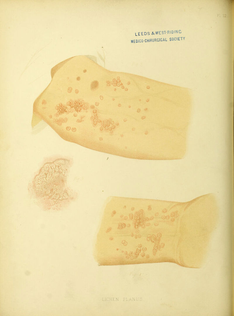 NIEDICO-CHIRURCICAL SOCIETY LICHEN PLANUS