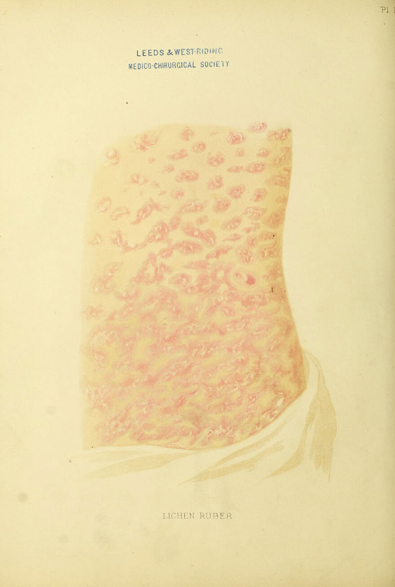 MEDiCO-CHIRURGICAL SOCIETY LICHEN RUBER