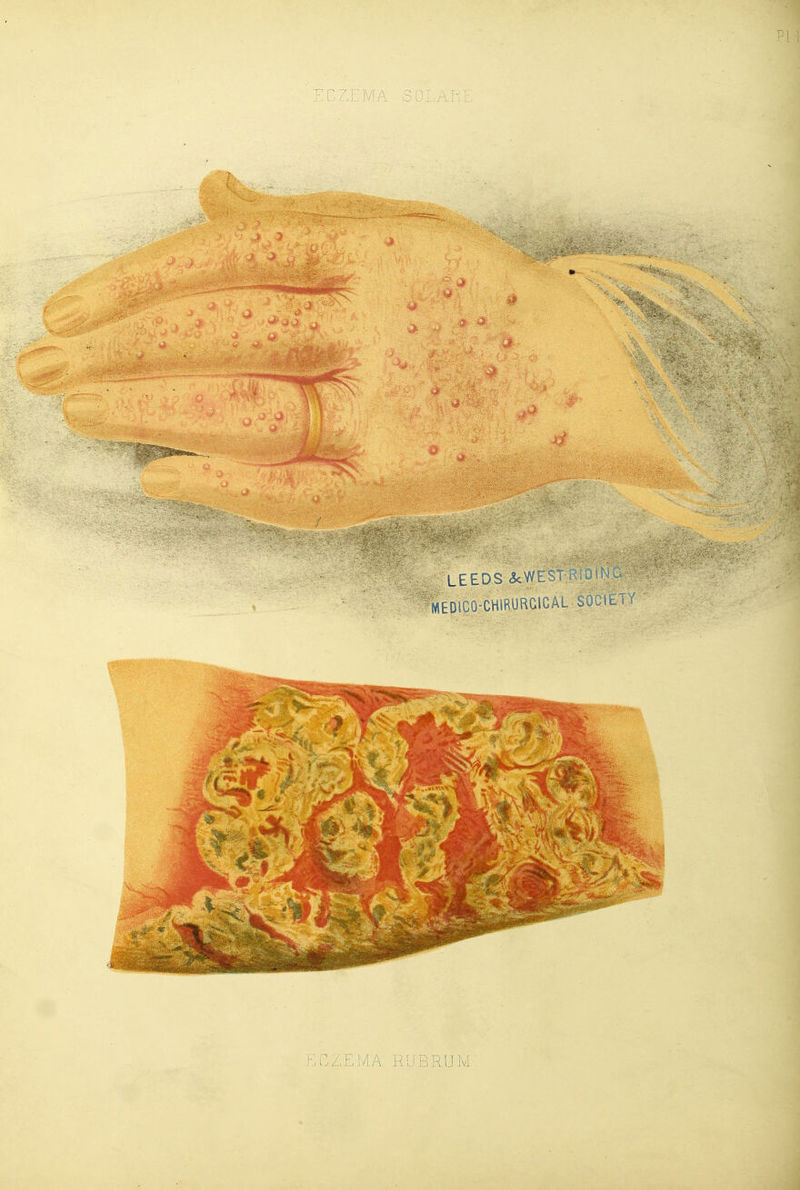 ECZ,FMA LEEDS <kVYEST:RU; WIEDICO-CHIRURGICAL SOCIETY ECZEMA RUBRUM
