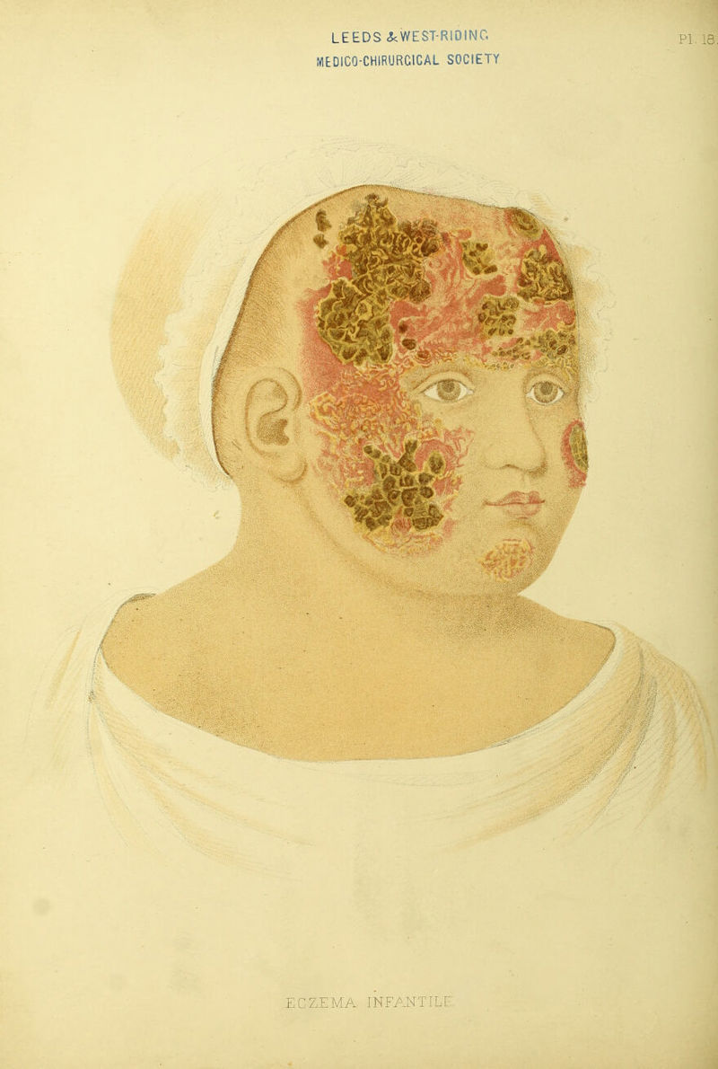 MEDICO-CHIRURCICAL SOCIETY ECZEMA INFANTILF