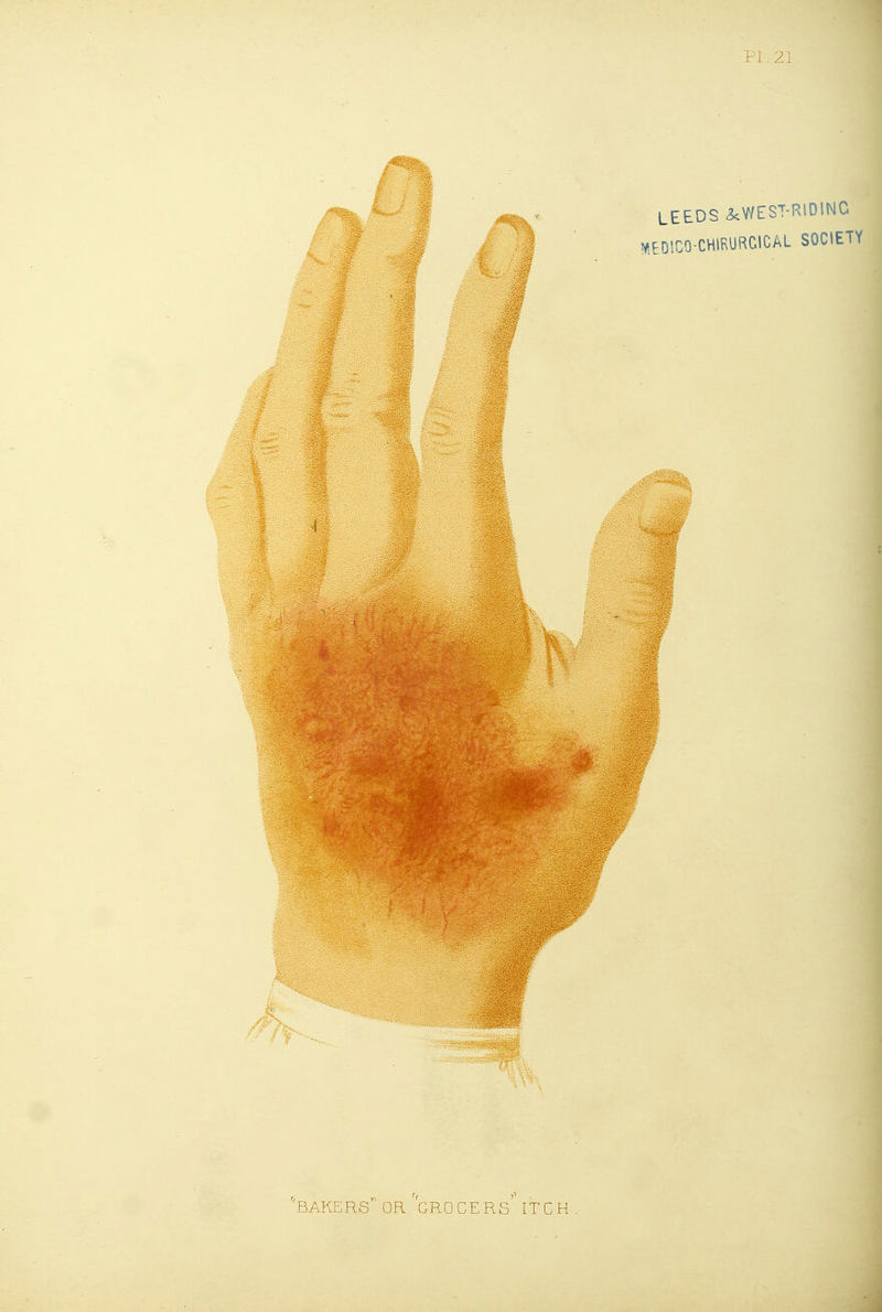 PI.21 LEEDS 3.WEST-RIDINC MEDICO-CHIRURCICAL SOCIETY i 'bakers'' or grocers'' itch