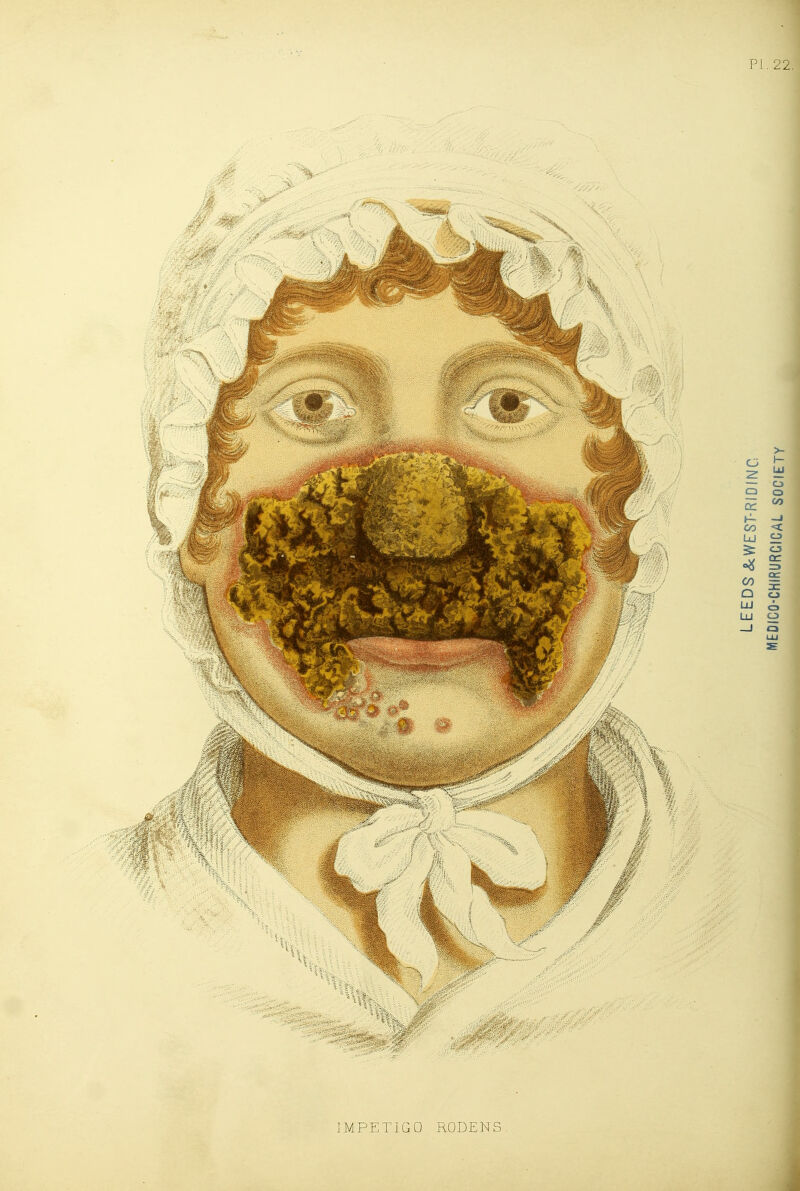 PI. 22, IMPETIGO RODENS