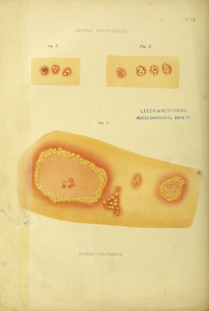 PI 25. LEEDS <ScWEST-RIDING MEDICO-CHIRURCICAL SOCIETY Fi^. 1. HERPES CmClNATUS