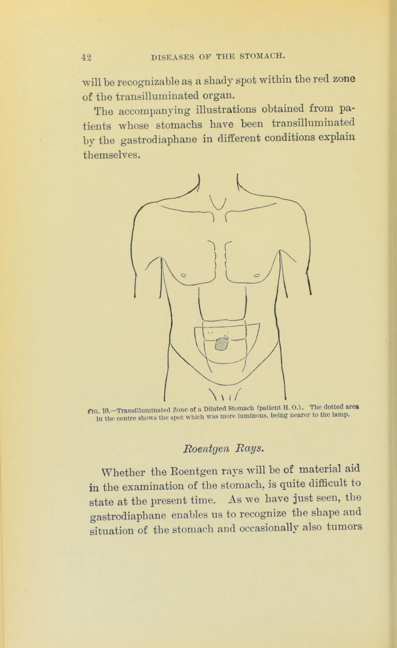 will be recognizable as a shady spot within the red zone of the transilliiminated organ. The accompanying illustrations obtained from pa- tients whose stomachs have been transilluminated by the gastrodiaphane in different conditions explain themselves. fTG lO.-Transilluminated Zone of a Dilated Stomach (patient H. O.). The dotted area in the centre shows the spot which was more luminous, being nearer to the lamp. Boentgen Bays. Whether the Eoentgen rays will be of material aid in the examination of the stomach, is quite difficult to state at the present time. As we have jtist seen, the gastrodiaphane enables us to recognize the shape and situation of the stomach and occasionally also tumors