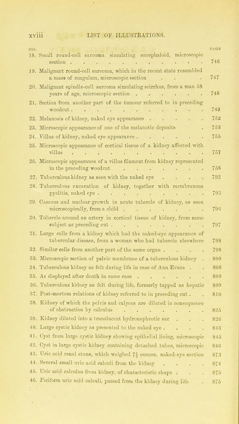 18. Small round-coll sarcoma simulating encephaloid, micrcscopic section . 746 19. Malignant round-cell sarcoma, which in the recent state resembled a mass of coagulum, microscopic section . . . 747 20. Malignant spindle-cell sarcoma simulating scirrhus, from a man .58 years of age, microscopic section ...... 748 21. Section from another part of the tumour referred to in preceding woodcut 749 22. Melanosis of kidney, naked eye appearance 23. Microscopic appearance of one of the melanotic deposits . 753 24. Villus of kidney, naked eye appearance 755 25. Microscopic appearance of cortical tissue of a kidney alfected with villus 757 26. Microscopic appearance of a villus filament from kidney represented in the preceding woodcut 758 27. Tuberculous kidney as seen with the naked eye .... 792 28. Tuberculous excavation of kidney, together with membranous pyelitis, naked eye .......... 793 29. Ciseous and nuclear growth in acute tubercle of kidney, as seen microscopically, from a child 796 30. Tubercle around an artery in cortical tissue of kidney, from same subject as preceding cut 797 31. Large cells from a kidney which had the uaked-eye appearance of tubercular disease, from a woman who had tubercle elsewhere 798 32. Similar cells from another part of the same organ .... 798 33. Microscopic section of pelvic membrane of a tuberculous kidney . . 800 34. Tuberculous kidney as felt during life in case of Ann Evans . . 808 35. As displayed after death in same case ...... 809 36. Tuberculous kidney as felt during life, formerly tapped as hepatic 809 37. Post-mortem relations of kidney referred to in preceding cut . . 810 38. Kidney of which the pelvis and calyces are dilated in consequence of obstruction by calculus 825 39. Kidney dilated into a translucent liydronephrotic sac . . . 826 40. Large cystic kidney as presented to the naked eye . . . .813 41. Cyst from large cystic kidney .showing epitlielial lining, microscopic 845 42. Cyst in large cystic kidney containing detached tubes, microscopic 846 43. Uric acid renal stone, which weighed 7i ounces, naked-eye section 873 44. Several small uric acid calculi from the kidney .... 874 45. Uric acid calculus from kidney, of characteristic shape ; . . 875 46. Pisiform uric acid calculi, passed from the kidney during life . 875