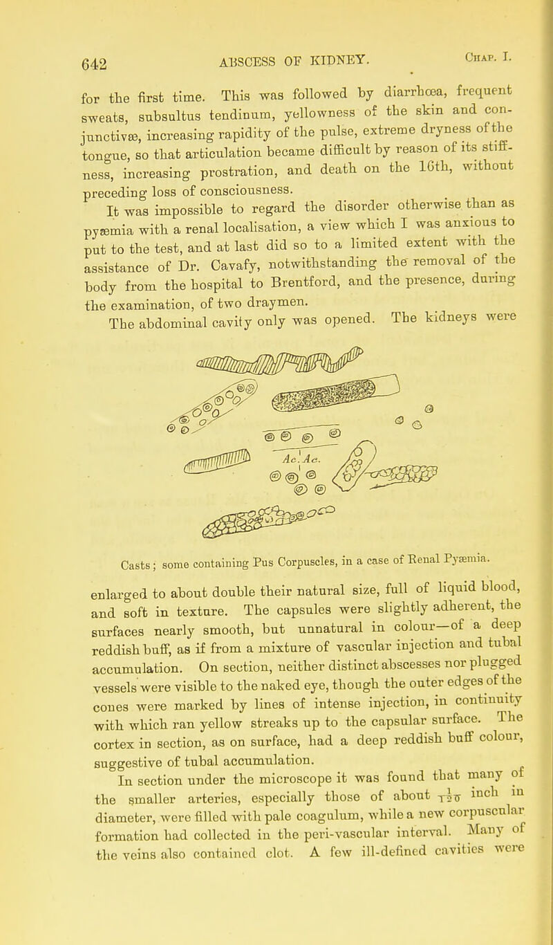 for the first time. This was followed by diarrhcea, frequent sweats, subsultus tendinum, yellowness of the skin and con- jnnctivffi, increasing rapidity of the pulse, extreme dryness of the tongue, so that articulation became difficult by reason of its stiff- ness, increasing prostration, and death on the IGth, without preceding loss of consciousness. It was impossible to regard the disorder otherwise than as pyjemia with a renal locahsation, a view which I was anxious to put to the test, and at last did so to a limited extent with the assistance of Dr. Cavafy, notwithstanding the removal of the body from the hospital to Brentford, and the presence, dunng the examination, of two draymen. The abdommal cavity only was opened. The kidneys were Casts; some containing Pus Corpuscles, in a case of Eeual Pysmia. enlarged to about double their natural size, full of liquid blood, and soft in texture. The capsules were slightly adherent, the surfaces nearly smooth, but unnatural in colour—of a deep reddish bufl, as if from a mixture of vascular injection and tubal accumulation. On section, neither distinct abscesses nor plugged vessels were visible to the naked eye, though the outer edges of the cones were marked by lines of intense injection, in continuity with which ran yellow streaks up to the capsular surface. The cortex in section, as on surface, had a deep reddish buff colour, suggestive of tubal accumulation. In section under the microscope it was found that many of the smaller arteries, especially those of about inch in diameter, were filled with pale coagulum, while a new corpuscular formation had collected in the peri-vascular interval. Many of the veins also contained clot. A few ill-defined cavities were