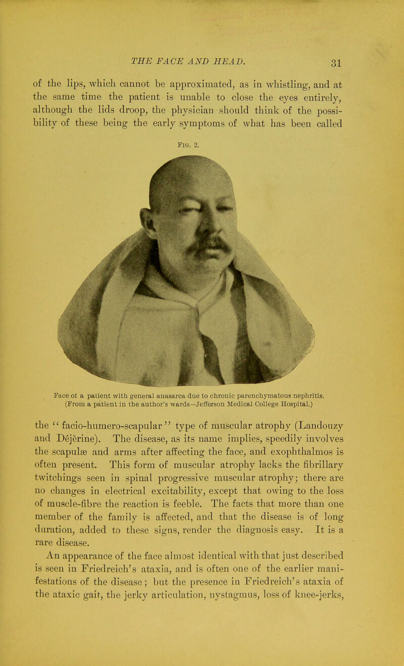 of the lips, which, cannot be approximated, as in wliistling, and at the same time the patient is unable to close the eyes entirely, although the lids droop, the physician should think of the possi- bility of these being the early symptoms of what has been called Fig. 2. Face ot a patient with general anasarca due to chronic parenchymatous nephritis. (From a patient in the author's wards—Jefferson Medical College Hospital.) the facio-humero-scapular  type of muscular atrophy (Landouzy and Dejerine). The disease, as its name implies, speedily involves the scapulae and arms after affecting the face, and exophthalmos is often present. This form of muscular atrophy lacks the fibrillary twitchings seen in spinal progressive muscular atrophy; there are no changes in electrical excitability, except that owing to the loss of muscle-fibre the reaction is feeble. The facts that more than one member of the family is affected, and that the disease is of long duration, added to these signs, render the diagnosis easy. It is a rare di.sease. An appearance of the face almost identical with that just described is seen in Friedreich's ataxia, and is often one of the earlier mani- festations of the disease; but the presence in Friedreich's ataxia of the ataxic gait, the jerky articulation, nystagmus, loss of knee-jerks.