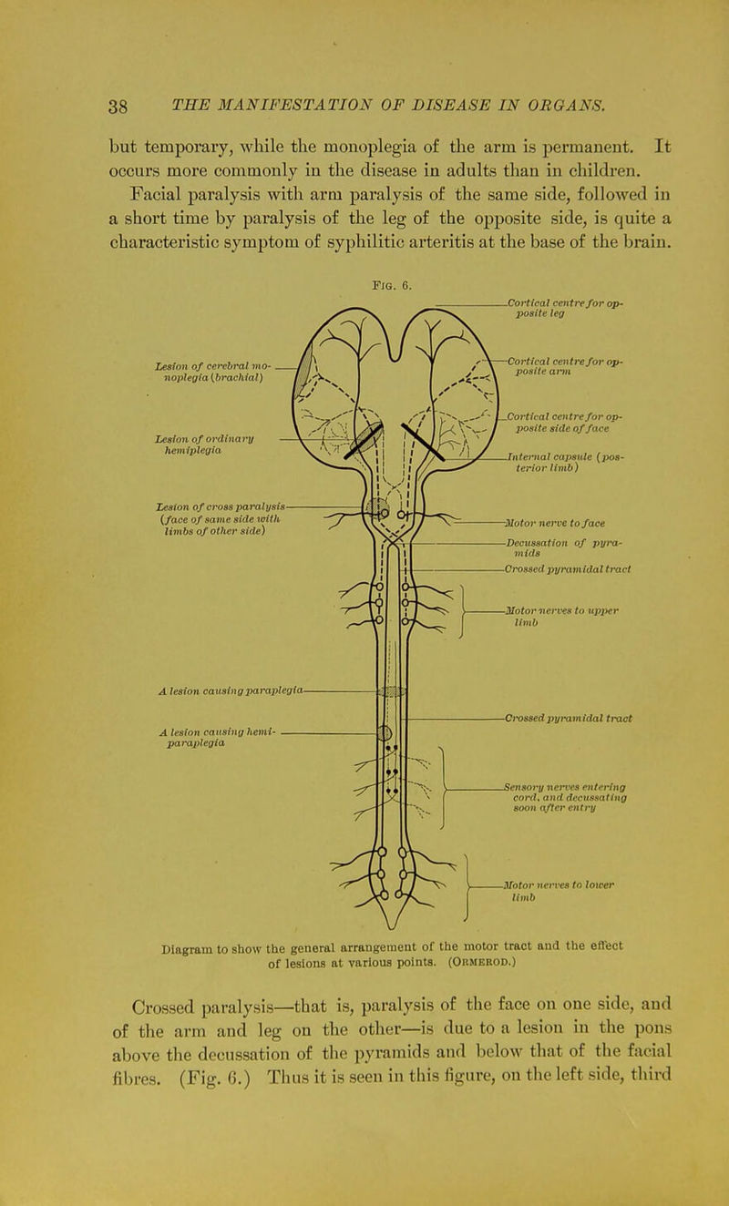 but temporary, while the monoplegia of the arm is permanent. It occurs more commonly in the disease in adults than in children. Facial paralysis with arm paralysis of the same side, followed in a short time by paralysis of the leg of the opposite side, is quite a characteristic symptom of syphilitic arteritis at the base of the Ijrain. Fig. 6. Lesion of cerebral ?ho- noplegfa [brachial) Lesion of ordtnaii/ Jiemlplegia Zeston of cross paralysis (face of same side with livibs of other side) A lesion causing paraplegia- A lesion causing hemi paraplegia Cortical centre for op- posite leg Cortical centre for op- posite ann Cortical centre for op- posite side of face Internal capsule (pos- terior limb) ■motor nerve to face Decussation of pyra- mids Crossed iiyramldal tract •Motor nerves to upjyer limb Crossed pyramidal tract Sensory nerves entering cord, and decussating soon after entry ■Motor nerves to lower limb Diagram to show the general arrangement of the motor tract and the effect of lesions at various points. (Ormebod.) Crossed paralysis—that is, paralysis of the face on one side, and of the arm and leg on the other—is due to a lesion in the pons above the decussation of the pyramids and below that of the facial fibres. (Fig. G.) Tims it is seen in this figure, on the left side, third