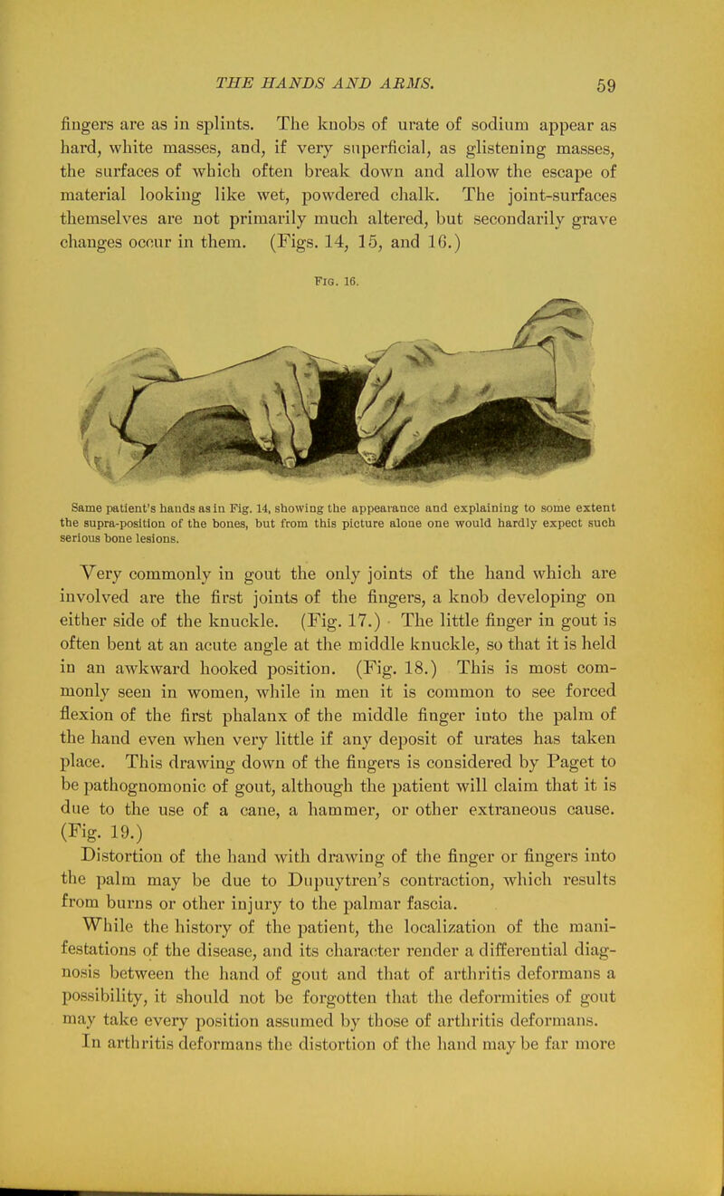 fingers are as in splints. The knobs of urate of sodium appear as hard, white masses, and, if very superficial, as glistening masses, the surfaces of which often break down and allow the escape of material looking like wet, powdered chalk. The joint-surfaces themselves are not primarily much altered, but secondarily grave changes occur in them. (Figs. 14, 15, and 16.) Fig. 16. Same patient's hands as in Fig. 14, showing the appearance and explaining to some extent the supra-posltion of the bones, but from this picture alone one would hardly expect such serious bone lesions. Very commonly in gout the only joints of the hand which are involved are the first joints of the fingers, a knob developing on either side of the knuckle. (Fig. 17.) The little finger in gout is often bent at an acute ang-le at the middle knuckle, so that it is held in an awkward hooked position. (Fig. 18.) This is most com- monly seen in women, while in men it is common to see forced flexion of the first phalanx of the middle finger into the palm of the hand even when very little if any deposit of urates has taken place. This drawing down of the fingers is considered by Paget to be pathognomonic of gout, although the patient will claim that it is due to the use of a cane, a hammer, or other extraneous cause. (Fig. 19.) Distortion of the hand with drawing of the finger or fingers into the palm may be due to Diipuytren's contraction, which results from burns or other injury to the palmar fascia. While the history of the patient, the localization of the mani- festations of the disease, and its character render a differential diag- nosis between the hand of gout and that of arthritis deformans a possibility, it should not be forgotten that the deformities of gout may take every position assumed by those of arthritis deformans. In arthritis deformans the distortion of the hand maybe far more