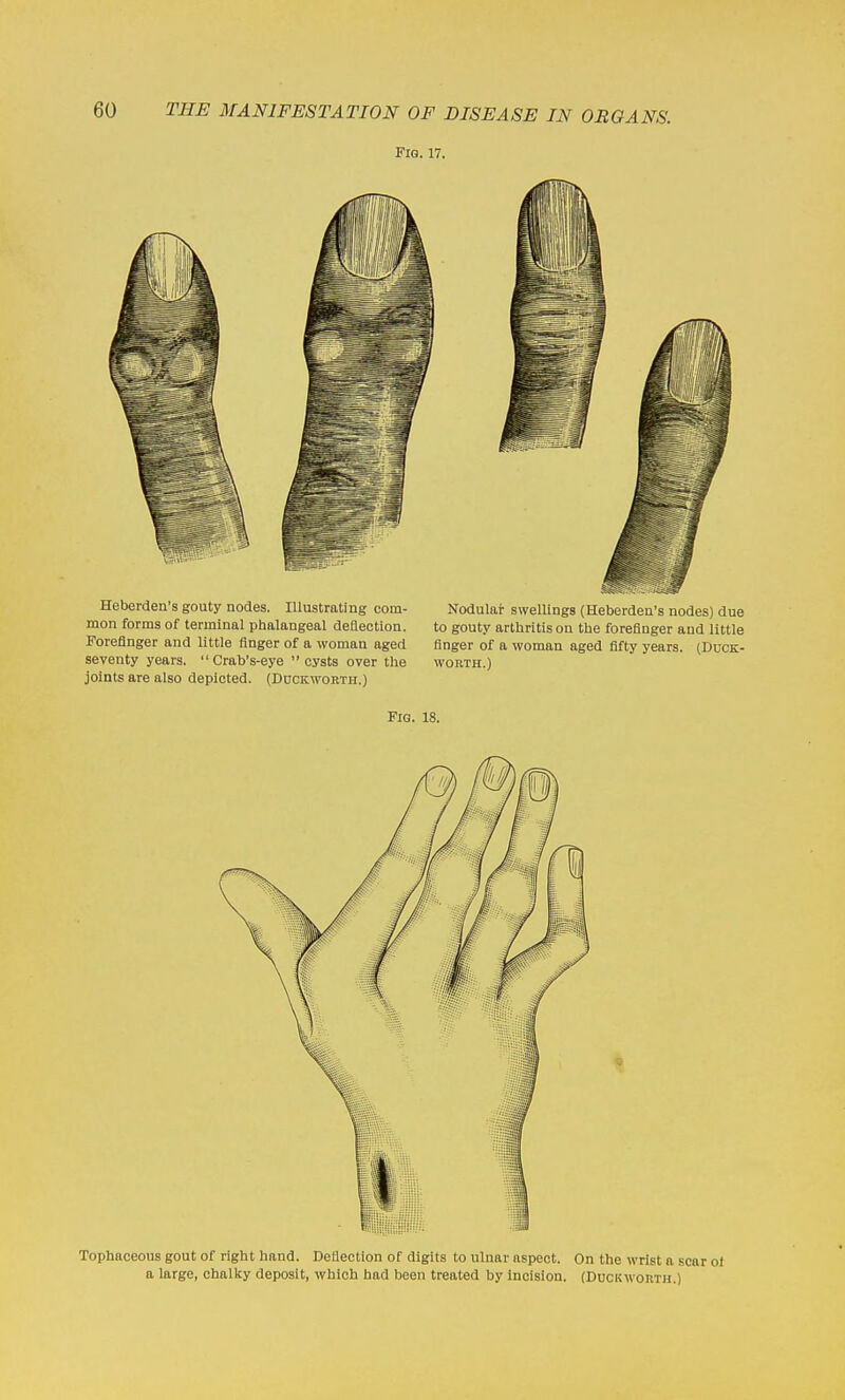 FlQ. 17. Heberden's gouty nodes. Illustrating com- Nodular swellings (Heberden's nodes) due mon forms of terminal phalangeal deflection. to gouty arthritis on the forefinger and little Forefinger and little finger of a woman aged finger of a woman aged fifty years. (Duck- seventy years.  Crab's-eye cysts over the worth.) joints are also depicted. (Duckworth.) Fig. 18. Tophaceous gout of right hand. Deflection of digits to ulnar aspect. On the wrist a scar of a large, chalky deposit, which had been treated by Incision. (Duckworth.)