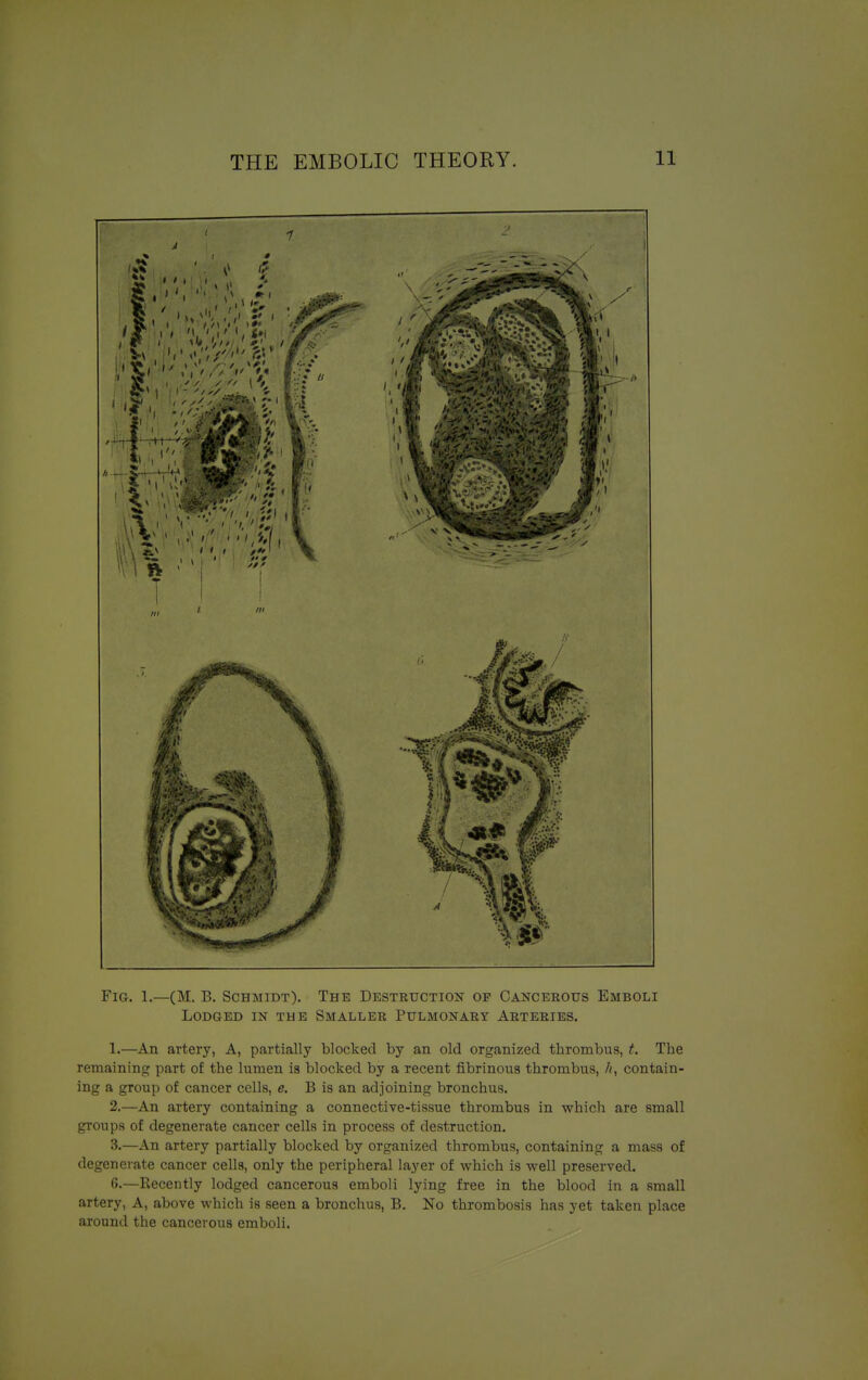 f 1 Fig. 1.—(M. B. Schmidt). The Destruction op Cancerous Emboli Lodged in the Smaller Pulmonary Arteries. 1. —An artery, A, partially blocked by an old organized thrombus, t. The remaining part of the lumen is blocked by a recent fibrinous thrombus, 7t, contain- ing a group of cancer cells, e. B is an adjoining bronchus. 2. —An artery containing a connective-tissue thrombus in which are small groups of degenerate cancer cells in process of destruction. 3. —An artery partially blocked by organized thrombus, containing a mass of degenerate cancer cells, only the peripheral layer of which is well preserved. 6.—Recently lodged cancerous emboli lying free in the blood in a small artery, A, above which is seen a bronchus, B. No thrombosis has yet taken place around the cancerous emboli.