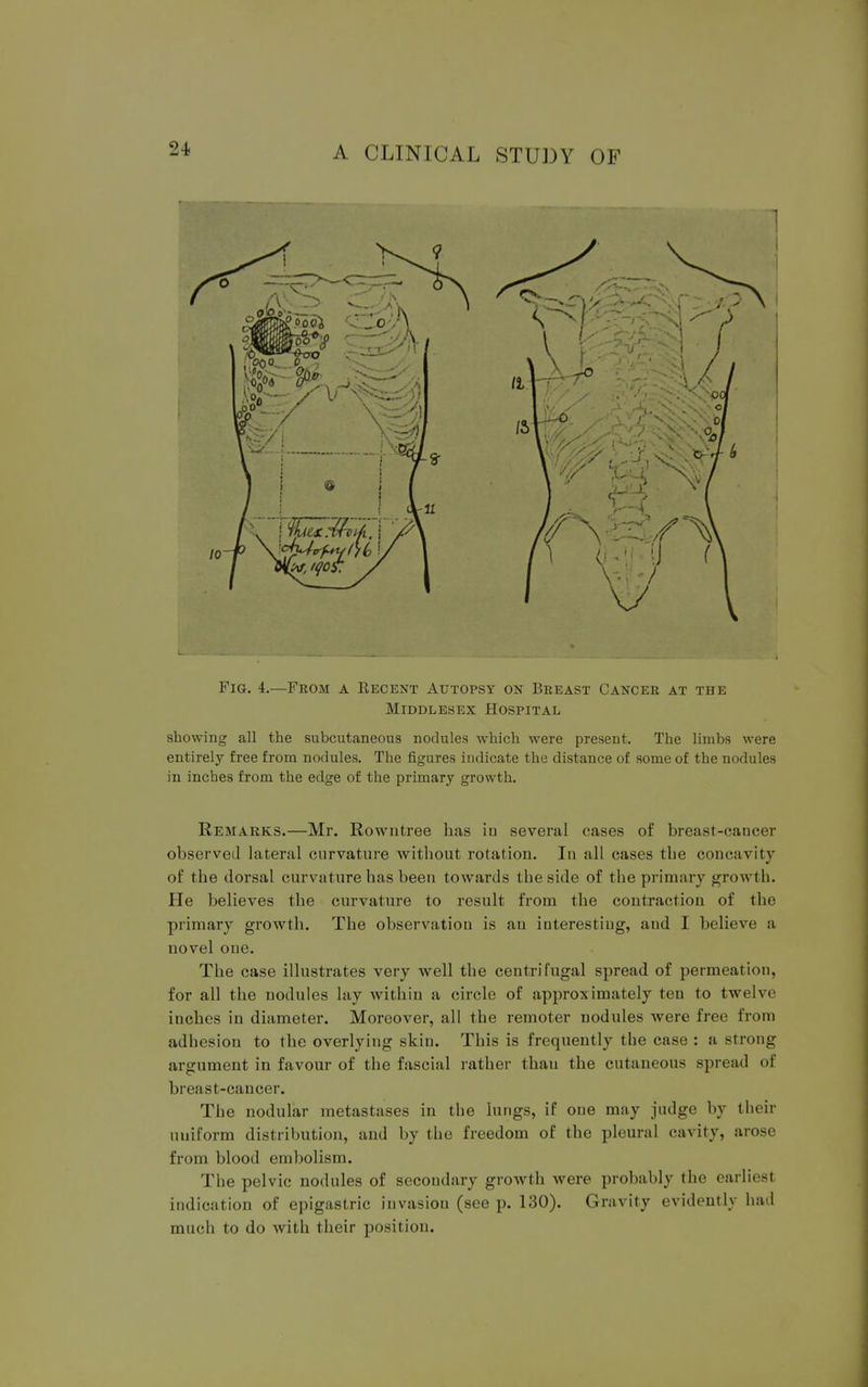 Fig. 4.—Feom a Becent Autopsy on Beeast Cancer at the Middlesex Hospital showing all the subcutaneous nodules which were present. The limbs were entirely free from nodules. The figures indicate the distance of some of the nodules in inches from the edge of the primary growth. Remarks.—Mr. Rowntree has iu several cases of breast-cancer observed lateral curvature without rotation. In all cases the concavity of the dorsal curvature has been towards the side of the primary growl h. He believes the curvature to result from the contraction of the primary growth. The observation is an interesting, and I believe a novel one. The case illustrates very well the centrifugal spread of permeation, for all the nodules lay within a circle of approximately ten to twelve inches in diameter. Moreover, all the remoter nodules were free from adhesion to the overlying skin. This is frequently the case : a strong argument in favour of the fascial rather than the cutaneous spread of breast-cancer. The nodular metastases in the lungs, if one may judge by their uuiform distribution, and by the freedom of the pleural cavity, arose from blood embolism. The pelvic nodules of secondary growth were probably the earliest indication of epigastric invasion (see p. 130). Gravity evidently had much to do with their position.