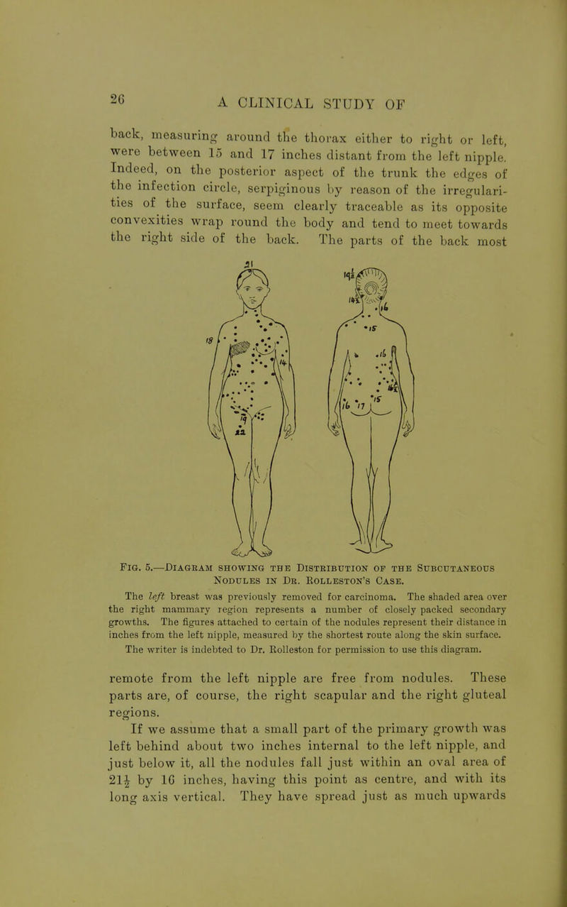 2G back, measuring around the thorax either to right or left, were between 15 and 17 inches distant from the left nipple! Indeed, on the posterior aspect of the trunk the edges of the infection circle, serpiginous by reason of the irregulari- ties of the surface, seem clearly traceable as its opposite convexities wrap round the body and tend to meet towards the right side of the back. The parts of the back most fig. 5.—diagram showing the distribution of the subcutaneous Nodules in Dr. Kolleston's Case. The left breast was previously removed for carcinoma. The shaded area over the right mammary region represents a number of closely packed secondary growths. The figures attached to certain of the nodules represent their distance in inches from the left nipple, measured by the shortest route along the skin surface. The writer is indebted to Dr. Rolleston for permission to use this diagram. remote from the left nipple are free from nodules. These parts are, of course, the right scapular and the right gluteal regions. If we assume that a small part of the primary growth was left behind about two inches internal to the left nipple, and just below it, all the nodules fall just within an oval area of 21^ by 1G inches, having this point as centre, and with its long axis vertical. They have spread just as much upwards