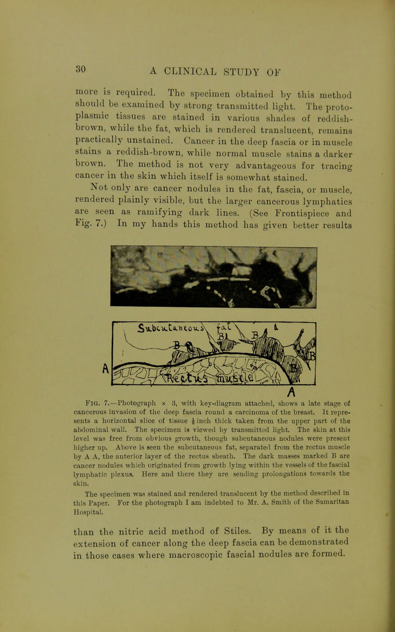 more is required. The specimen obtained by this method should be examined by strong transmitted light. The proto- plasmic tissues are stained in various shades of reddish- brown, while the fat, which is rendered translucent, remains practically unstained. Cancer in the deep fascia or in muscle stains a reddish-brown, while normal muscle stains a darker brown. The method is not very advantageous for tracing cancer in the skin which itself is somewhat stained. Not only are cancer nodules in the fat, fascia, or muscle, rendered plainly visible, but the larger cancerous lymphatics are seen as ramifying dark lines. (See Frontispiece and Fig. 7.) In my hands this method has given better results A Fig. 7.—Photograph x 3, with key-diagram attached, shows a late stage of cancerous invasion of the deep fascia round a carcinoma of the breast. It repre- sents a horizontal slice of tissue J inch thick taken from the upper part of the abdominal wall. The specimen is viewed by transmitted light. The skin at this level was free from obvious growth, though subcutaneous nodules were present higher up. Above is seen the subcutaneous fat, separated from the rectus muscle by A A, the anterior layer of the rectus sheath. The dark masses marked B are cancer nodules which originated from growth lying within the vessels of the fascial lymphatic plexus. Here and there they are sending prolongations towards the skin. The specimen was stained and rendered translucent by the method described in this Paper. For the photograph I am indebted to Mr. A. Smith of the Samaritan Hospital. than the nitric acid method of Stiles. By means of it the extension of cancer along the deep fascia can be demonstrated in those cases where macroscopic fascial nodules are formed.