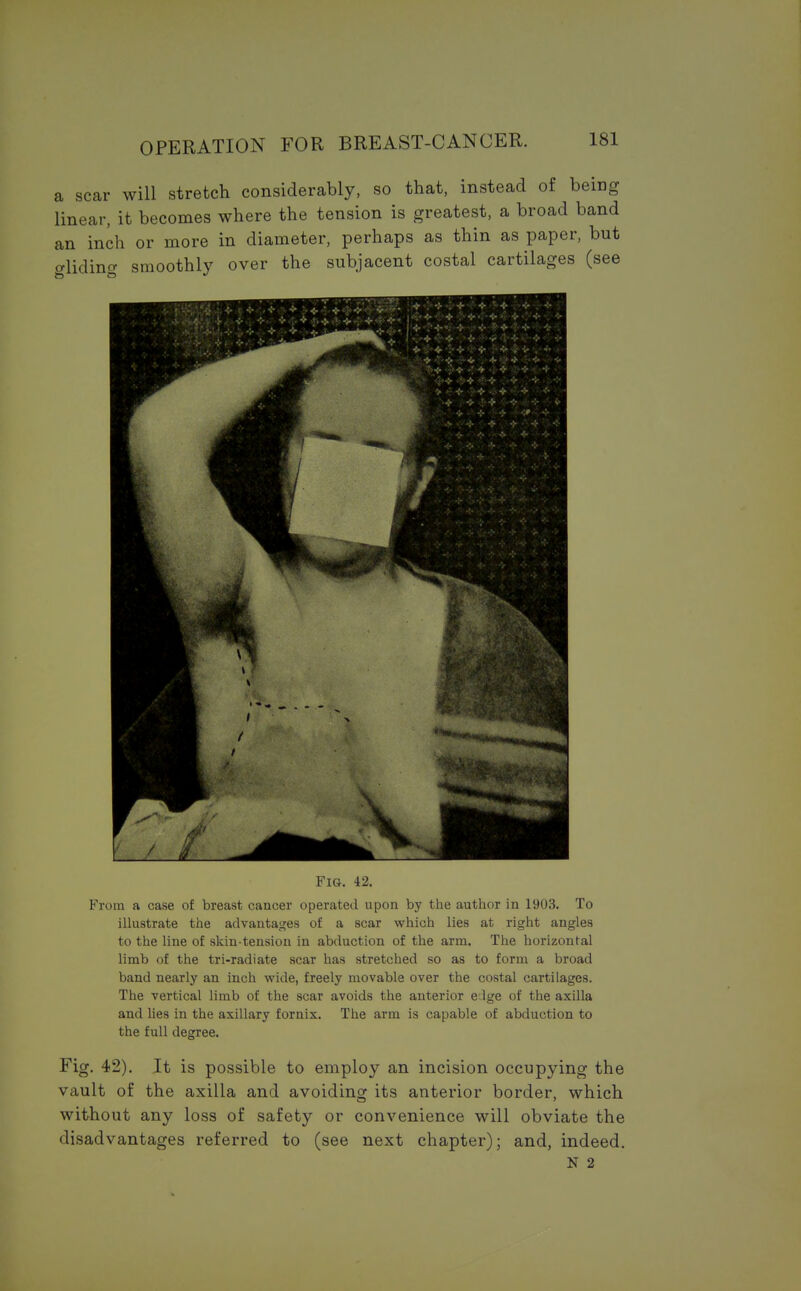 a scar will stretch considerably, so that, instead of being linear, it becomes where the tension is greatest, a broad band an inch or more in diameter, perhaps as thin as paper, but alidino- smoothly over the subjacent costal cartilages (see Fig. 42. From a case of breast cancer operated upon by the author in 1903. To illustrate the advantages of a scar which lies at right angles to the line of skin-tension in abduction of the arm. The horizontal limb of the tri-radiate scar has stretched so as to form a broad band nearly an inch wide, freely movable over the costal cartilages. The vertical limb of the scar avoids the anterior e:lge of the axilla and lies in the axillary fornix. The arm is capable of abduction to the full degree. Fig. 42). It is possible to employ an incision occupying the vault of the axilla and avoiding its anterior border, which without any loss of safety or convenience will obviate the disadvantages referred to (see next chapter); and, indeed. N 2