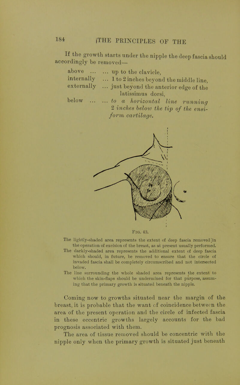 I s-t If the growth starts under the nipple the deep fascia should accordingly be removed— above ... internally externally below ... . up to the clavicle, . 1 to 2 inches beyond the middle line, . just beyond the anterior edge of the latissimus dorsi, . to a horizontal line running 2 inches below the tip of the ensi- form cartilage. Fig. 43. The lightly-shaded area represents the extent of deep fascia removed [in the operation of excision of the breast, as at present usually performed. The darkly-shaded area represents the additional extent of deep fascia which should, in future, be removed to ensure that the circle of invaded fascia shall be completely circumscribed and not intersected below. The line surrounding the whole shaded area represents the extent to which the skin-flaps should be undermined for that purpose, assum- ing that the primary growth is situated beneath the nipple. Coming now to growths situated near the margin of the breast, it is probable that the want of coincidence between the area of the present operation and the circle of infected fascia in these eccentric growths largely accounts for the bad prognosis associated with them. The area of tissue removed should be concentric with the nipple only when the primary growth is situated just beneath