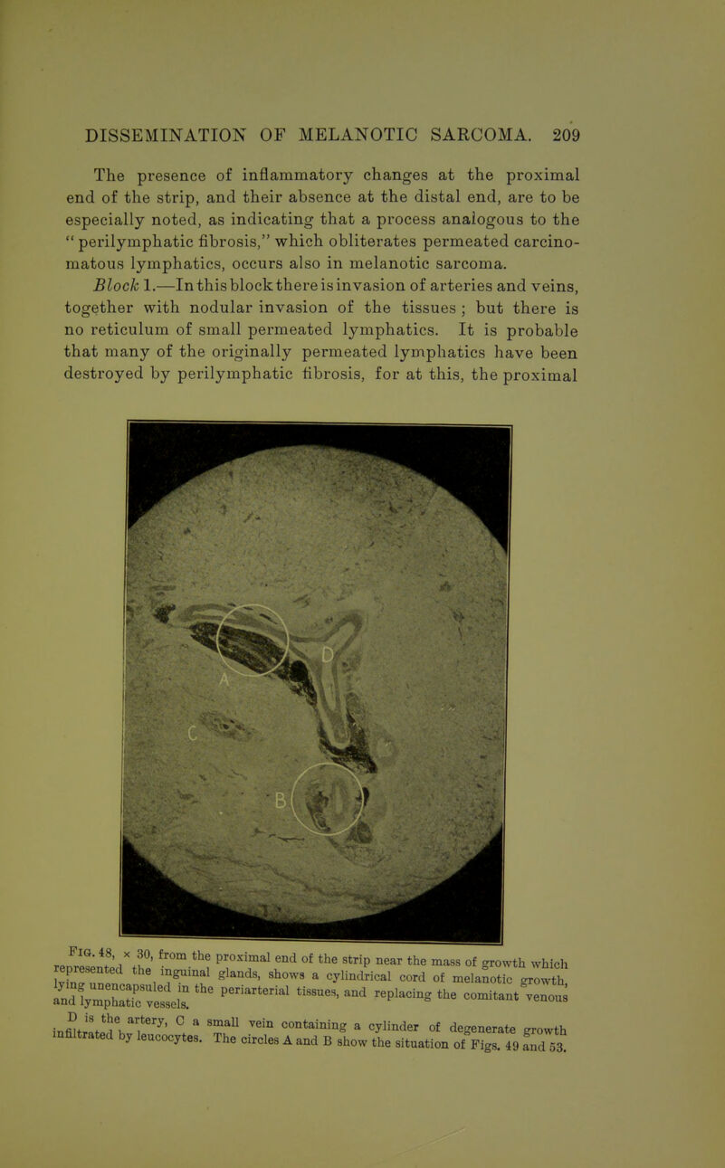 The presence of inflammatory changes at the proximal end of the strip, and their absence at the distal end, are to be especially noted, as indicating that a process analogous to the  perilymphatic fibrosis, which obliterates permeated carcino- matous lymphatics, occurs also in melanotic sarcoma. Block 1.—In this block there is invasion of arteries and veins, together with nodular invasion of the tissues ; but there is no reticulum of small permeated lymphatics. It is probable that many of the originally permeated lymphatics have been destroyed by perilymphatic fibrosis, for at this, the proximal rJSnLxth« £r-tb; pnmal tnd of the strip near the mass °f represented the inguinal glands, shows a cylindrical cord of melanotic growth ^Wlc^£ ^ Peiiarterial ti88U6S' ^ r ^ -*«us i^Jl^lT17' ° 8 9maU V6in containi°g a cylinder of degenerate growth infiltrated by leucocytes. The circles A and B show the situation of Figs. 49 fnd73.