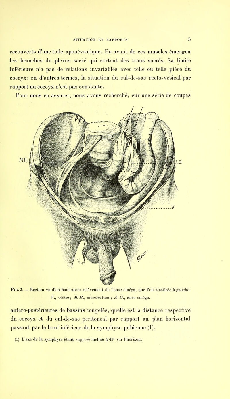 recouverts d'une toile aponévrotique. En avant de ces muscles émergen les branches du plexus sacré qui sortent des trous sacrés. Sa limite inférieure n'a pas de relations invariables avec telle ou telle pièce du coccyx; en d'autres termes, la situation du cul-de-sac recto-vésical par rapport au coccyx n'est pas constante. Pour nous en assurer, nous avons recherché, sur une série de coupes FiG. 2. — Rectum vu d'en haut après relèvement de l'anse oméga, que l'on a attirée il gauche. V.. vessie ; M. i?., mésorectum ; A. 0., anse oméga. antéro-postérieures de bassins congelés, quelle est la distance respective du coccyx et du cul-de-sac péritonéal par rapport au plan horizontal passant par le bord inférieur de la symphyse pubienne (1). (1) L'axe de la symph5'se étant supposé incliné à 45° sur l'horizon. /