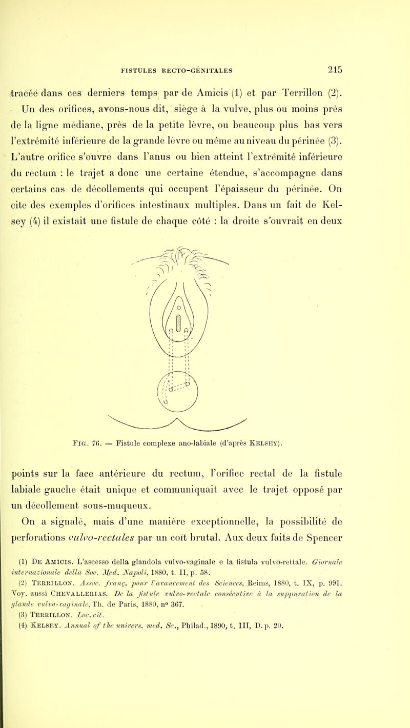 tracée dans ces derniers temps par de Amicis (1) et par Terrillon (2). Un des orifices, avons-nous dit, siège à la vulve, plus ou moins près de la ligne médiane, près de la petite lèvre, ou beaucoup plus bas vers l'extrémité inférieure de la grande lèvre ou môme au niveau du périnée (3). L'autre orifice s'ouvre dans l'anus ou bien atteint l'extrémité inférieure du rectum : le trajet a donc une certaine étendue, s'accompagne dans certains cas de décollements qui occupent l'épaisseur du périnée. On cite des exemples d'orifices intestinaux multiples. Dans un fait de Kel- sey (4) il existait une fistule de chaque côté : la droite s'ouvrait en deux FiG. 76. — Fistule complexe ano-laLiale (d'après Kelsey). points sur la face antérieure du rectum, l'orifice rectal de la fistule labiale gauche était unique et communiquait avec le trajet opposé par un décollement sous-muqueux. On a signalé, mais d'une manière exceptionnelle, la possibilité de perforations vulvo-rectales par un coït brutal. Aux deux faits de Spencer (1) De Amicis. L'ascesso délia glandola viilvo-vaginale e la fistula vulvo-rettale. Giurnale intcrnaztonale délia Soc. M_ed. Napoli. 1880, t. II, p. 58. (2) TEERiiiLON. Aîsoc. franç. pour l'avancement des Sciences, Reims, 1880, t. IX, p. 991. Voy. aussi Chevallerias. De la fistule vulro-rectale consécutive à la, stippuration de la fllande vulro-cai/ina le, Th. de Paris, 1880, n° 367. (3) Terrillon. Loc.cit. (4) Kelsey. Anmial of the vnirers. med. Se, Philad., 1890, t. III, D. p. 20.