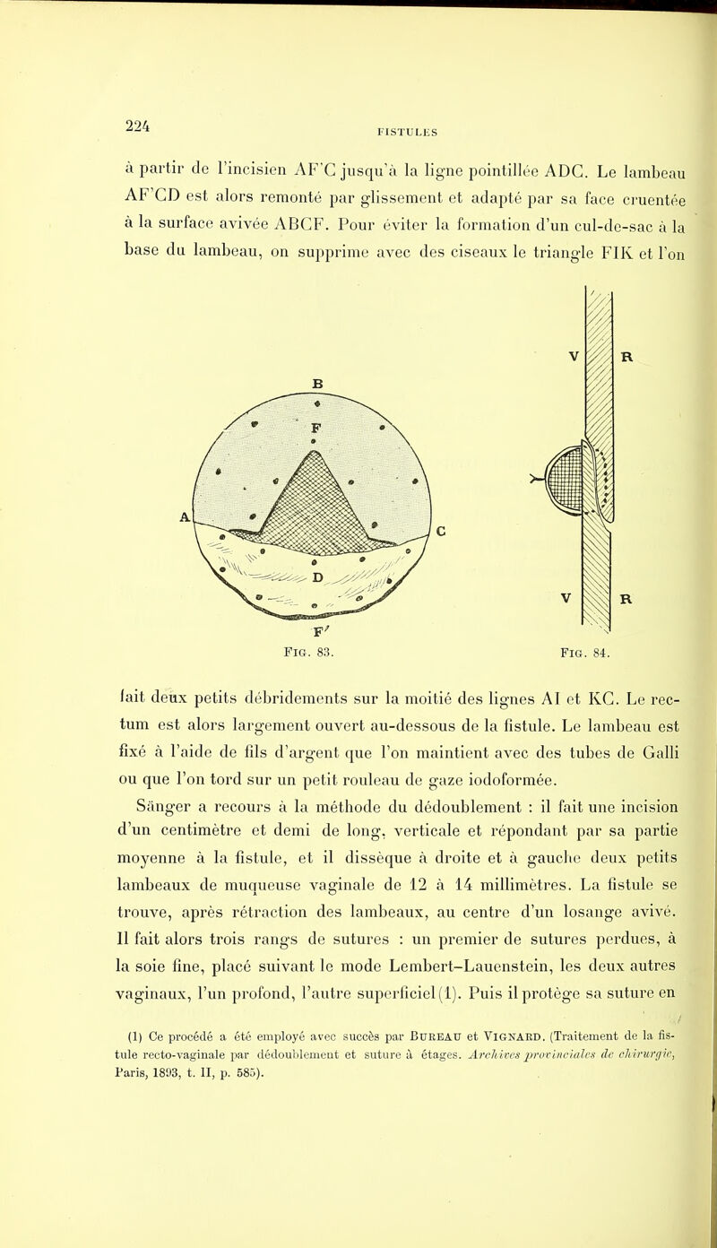 FISTULES à partir de l'incisien AFG jusqu'à la ligne pointillée ADC. Le lambeau AF'GD est alors remonté par glissement et adapté par sa face cruentée à la surface avivée ABGF. Pour éviter la formation d'un cul-de-sac à la base du lambeau, on supprime avec des ciseaux le triangle FIK et l'on FiG. 83. FiG. 84. lait deux petits débridements sur la moitié des lignes AI et KG. Le rec- tum est alors largement ouvert au-dessous de la fistule. Le lambeau est fixé à l'aide de fîls d'argent que l'on maintient avec des tubes de Galli ou que l'on tord sur un petit rouleau de gaze iodoformée. Sânger a recours à la méthode du dédoublement : il fait une incision d'un centimètre et demi de long, verticale et répondant par sa partie moyenne à la fistule, et il dissèque à droite et à gauche deux petits lambeaux de muqueuse vaginale de 12 à 14 millimètres. La fistule se trouve, après rétraction des lambeaux, au centre d'un losange avivé. Il fait alors trois rangs de sutures : un premier de sutures perdues, à la soie fine, placé suivant le mode Lembert-Lauenstein, les deux autres vaginaux, l'un profond, l'autre superficiel (1). Puis il protège sa suture en (1) Ce procédé a été employé avec succès par BUREAU et VlGNARD. (Traitement de la fis- tule recto-vaginale par dédoublement et suture à étages. Archives j^irvrincialcs de cMmrgic, Paris, 1893, t. II, p. 585).