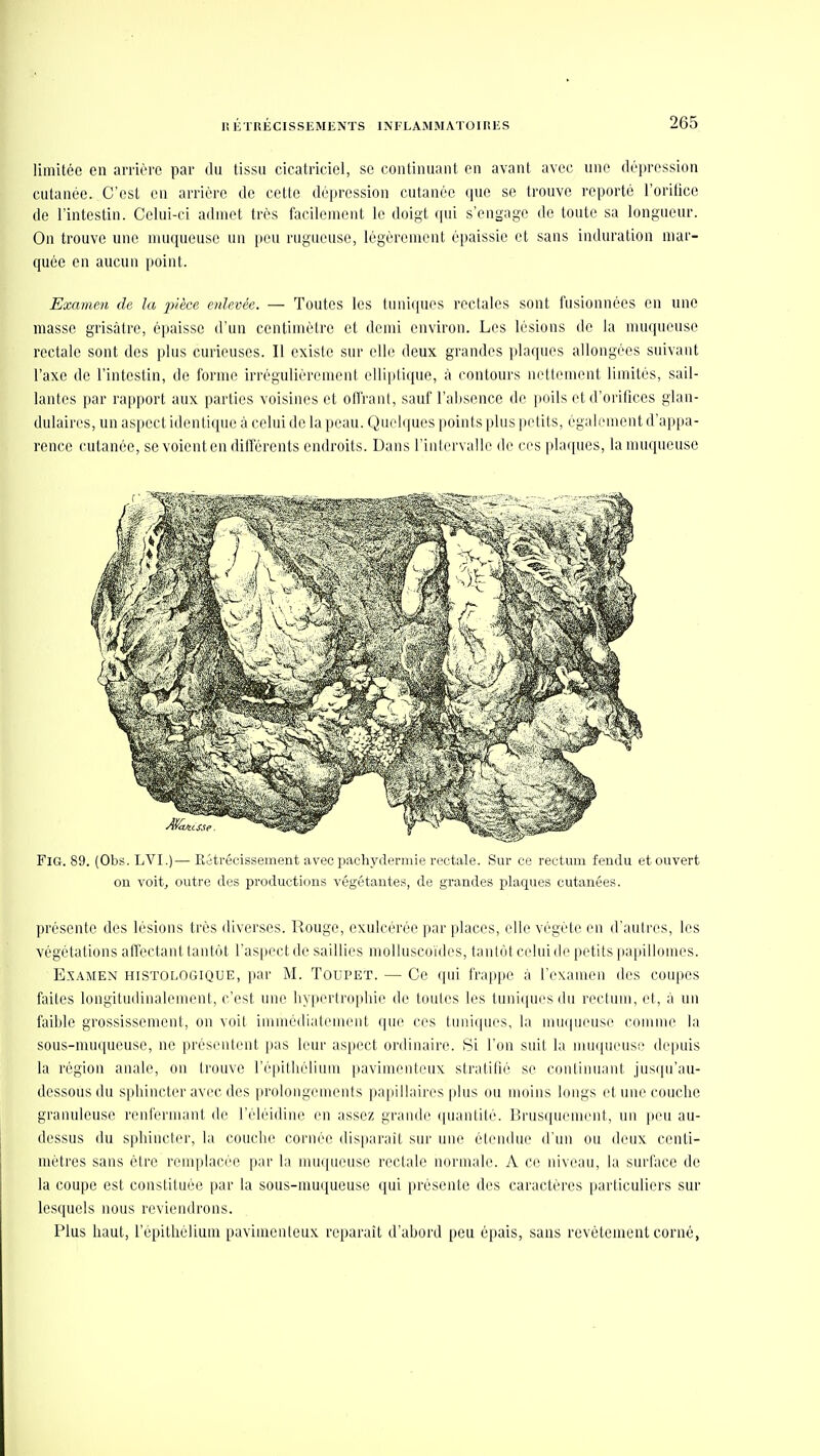 limitée en arnùrc par du tissu cicatriciel, se continuant en avant avec une dépression cutanée. C'est en arrière de cette dépression cutanée que se trouve reporté l'oritice de l'intestin. Celui-ci admet très facilement le doigt qui s'engage de toute sa longueur. On trouve une muqueuse un peu rugueuse, légèrement épaissie et sans induration mar- quée en aucun point. Examen de la x>ièce enlevée. — Toutes les tuniques rectales sont fusionnées en une masse gristàtre, épaisse d'un centimètre et demi environ. Les lésions de la nuupieuse rectale sont des plus curieuses. Il existe sur elle deux grandes plaques allongées suivant l'axe de l'intestin, de forme irrégulièrement eiliplique, à contours nettement limités, sail- lantes par ra|)port aux parties voisines et oH'ranl, sauf l'absence de i)oils et d'orifices glan- dulaires, un aspect identique à celui de la peau. Qu('l([ues points plus petits, également d'appa- rence cutanée, se voient en différents endroits. Dans riiilervalle de ci's plaques, la muqueuse FlG. 89. (Obs. LVI.)— Rétrécissement avec pacliydermie rectale. Sur ce rectum feudu et ouvert ou voit, outre des productions végétantes, de grandes plaques cutanées. présente des lésions très diverses. Rouge, exulcérée par places, elle végète en d'aulres, les végétations affectant tantôt l'aspect de saillies molluscoïdes, tantôt celui (b' petits papiilomes. Ex.\MEN HiSTOLOGiQUE, par M. TouPET. — Ce qui frappe à l'examen des coupes faites longitudinalement, c'est une liyiierlropliie de foules les tuni(piesdu rectum, el, à un faible grossissement, on voit iinniédiatement que ces tuiii(|ues, la nuKpieuse comme la sous-muqueuse, ne présentent pas leur aspect ordinaire. Si l'on suit la iinKpieuse depuis la région anale, on trouve l'épitliélium pavimenteux stratifié se continuant jusipi'au- dessousdu s|)bincter avec des prolongements papillaires plus ou moins longs et une couche granuleuse renfermant de l'éléidine en assez grande (piantité. Brusquement, un peu au- dessus du sphincter, la couche cornée disparait sur une étendue d'un ou deux centi- mètres sans être renqjlacée par la muqueuse rectale normale. A ce niveau, la surface de la coupe est constituée par la sous-nm(iueuse qui présente des caractères [larticuliers sur lesquels nous reviendrons. Plus haut, l'épitliélium pavimenteux reparaît d'abord peu épais, sans revêtement corné,