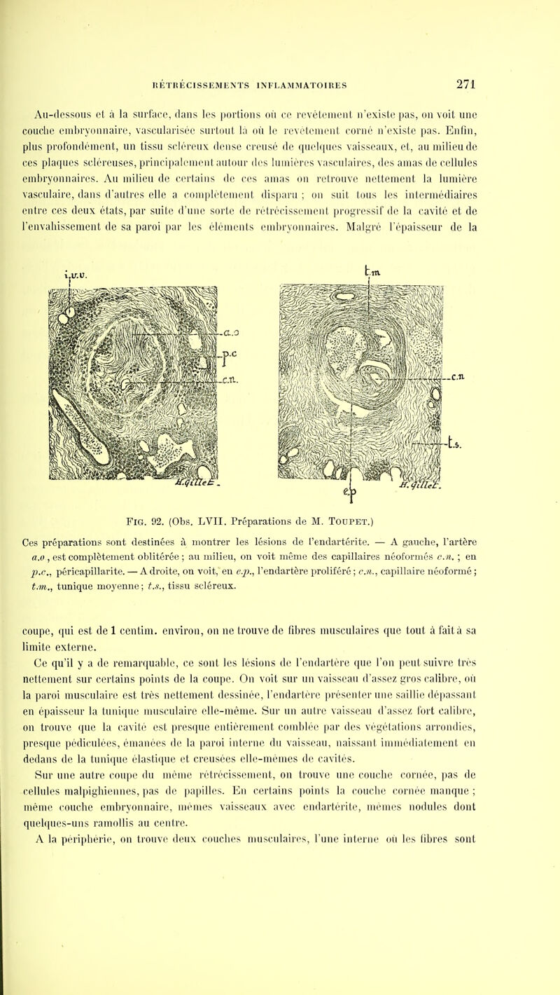 Au-(lossous cl à la surface, dans les portions on ce revèlenieni, n'existe pas, on voit une couche embryonnaire, vascularisée surtout lu où le l'cvi'lenient corné n'existe pas. Enfin, plus profondément, un tissu scléreux dense creusé de quehpies vaisseaux, et, au milieu de ces plaques sclércuses, principalement autour des lumières vasculaires, des amas de cellules embryonnaires. Au milieu de certains de ces amas on retrouve nettement la lumière vasculaire, dans d'autres elle a coniplètenient (lis|taru ; on suit tous les intermédiaires entre ces deux états, par suite d'une sorte de rétrécissement progressif de la cavité et de l'envahissement de sa paroi par les éléments embryonnaires. Malgré l'épaisseur de la FiG. 92. (Obs. LVII. Préparations de M. Todpet.) Ces préparations sont destinées à montrer les lésions de l'endartérite. — A gauche, l'artère «.y , est complètement oblitérée ; au milieu, on voit même des capillaires néoformés en. ; en p.o., péricapillarite. — A droite, on voit, en l'endartère proliféré ; e./i., capillaire néoformé ; t.vi., tunique moyenne ; t.s., tissu scléreux. coupe, qui est de 1 ccntim. environ, on ne trouve de fibres musculaires que tout à fait à sa limite externe. Ce qu'il y a de remarquable, ce sont les lésions de l'endartère que l'on peut suivre très nettement sur certains points de la coupe. On voit sur un vaisseau d'assez gros calibre, où la paroi musculaire est très nettement dessinée, l'endartère présenter une saillie dépassant en épaisseur la tunique nuisculaire elle-même. Sur un autre vaisseau d'assez fort calibre, on trouve que la cavité est pres(pie entièrement comblée par des végétations arrondies, presque pédiculées, émanées de la paroi interne du vaisseau, naissant immédiatement en dedans de la tunique élastique et creusées elle-mémes de cavités. Sur une autre coupe du même rétrécissement, on trouve une couche cornée, pas de cellules malpigliiennes, pas de papilles. En certains points la couche cornée manque ; même couche embryonnaire, mêmes vaisseaux avec endartérite, mêmes nodules dont quelques-uns ramollis au centre. A la péri]dierie, on trouve deux couches nmscnlaires, l'une interne où les fibres sont