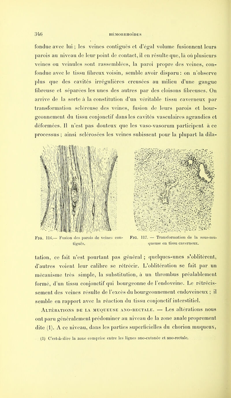 fondue avec lui ; les veines contiguës et d'ég-al volume fusionnent leurs parois au niveau de leur point de contact, il en résulte que, là où plusieurs veines ou veinules sont rassemblées, la paroi propre des veines, con- fondue avec le tissu fibreux voisin, semble avoir disparu: on n'observe plus que des cavités irrégulières creusées au milieu d'une gangue fibreuse et séparées les unes des autres par des cloisons fibreuses. On arrive de la sorte à la constitution d'un véritable tissu caverneux par transformation scléreuse des veines, fusion de leurs parois et bour- geonnement du tissu conjonctif dans les cavités vasculaires agrandies et déformées. Il n'est pas douteux que les vaso-vasorum participent à ce processus ; ainsi sclérosées les veines subissent pour la plupart la dila- FlG. UG — Fusion des parois de veines con- FiG. 117. — Transformation de la sous-mu- tiguës. queuse en tissu caverneux. tation, ce fait n'est pourtant pas général ; quelques-unes s'oblitèrent, d'autres voient leur calibre se rétrécir. L'o])litération se fait par un mécanisme très simple, la substitution, à un tlirombus préalablement formé, d'un tissu conjonctif qui bourgeonne de Tendoveine. Le rétrécis- sement des veines résulte de l'excès du bourgeonnement endoveineux ; il semble en rapport avec la réaction du tissu conjonctif interstitiel. Altér.itions de la muqueuse ano-rectale. — Les altérations nous ont paru généralement prédominer au niveau de la zone anale proprement dite (1). A ce niveau, dans les parties superficielles du chorion muqueux, (1) C'est-à-dire la zone comprise entre les lignes ano-cutanée et ano-rectale.