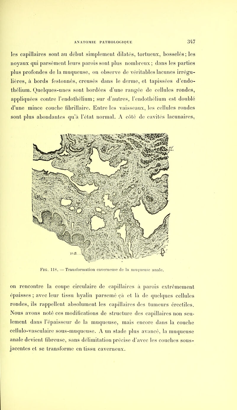 les capillaires sont au début simplement dilatés, tortueux, bosselés; les noyaux qui parsèment leurs parois sont plus nombreux ; dans les parties plus profondes de la muqueuse, on observe de véritables lacunes irrégu- lières, à bords festonnés, creusés dans le derme, et tapissées d'endo- thélium. Quelques-unes sont bordées d'une rangée de cellules rondes, appliquées contre l'endothélium; sur d'autres, l'endothélium est doublé d'une mince coucbe fîbrillaire. Entre les vaisseaux, les cellules rondes sont plus abondantes qu'à l'état normal. A côté de cavités lacunaires, FiG. lis. — Transformation caverneuse de la muqueuse anale. on rencontre la coupe circulaire de capillaires à parois extrêmement épaisses ; avec leur tissu byalin parsemé çà et là de quelques cellules rondes, ils rappellent absolument les capillaires des tumeurs érectiles. Nous avons noté ces modifications de structure des capillaires non seu- lement dans l'épaisseur de la muqueuse, mais encore dans la couche cellulo-vasculaire sous-muqueuse. A un stade plus avancé, la muqueuse anale devient fibreuse, sans délimitation précise d'avec les couches sous- jacentes et se transforme en tissu caverneux.