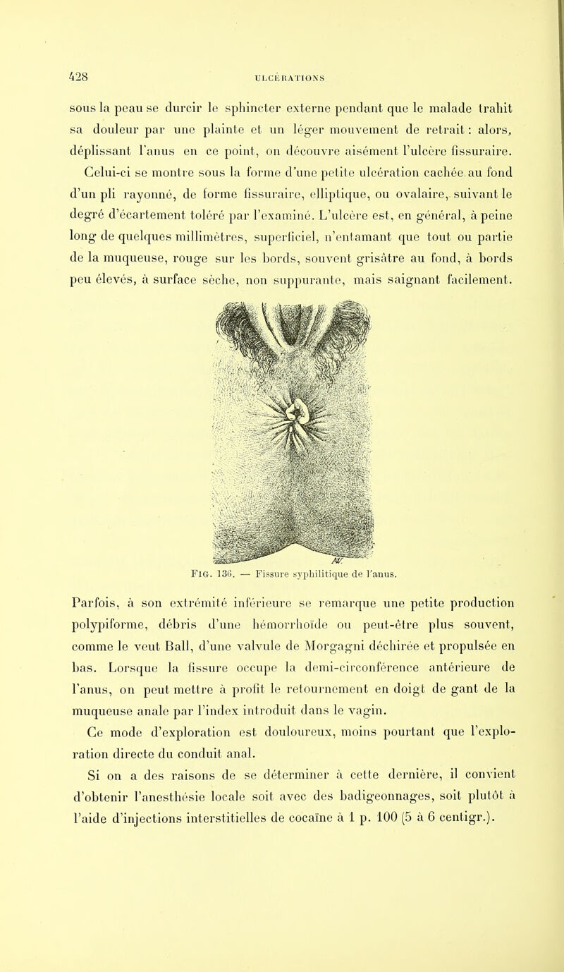 SOUS la peau se durcir le sphincter externe pendant que le malade trahit sa douleur par une plainte et un léger mouvement de retrait : alors, déplissant l'anus en ce point, on découvre aisément l'ulcère fissuraire. Celui-ci se montre sous la forme d'une petite ulcération cachée au fond d'un pli rayonné, de forme fissuraire, elliptique, ou ovalaire, suivant le degré d'écartement toléré par l'examiné. L'ulcère est, en généi-al, à peine long de quelques millimètres, superficiel, n'entamant que tout ou partie de la muqueuse, rouge sur les bords, souvent grisâtre au fond, à bords peu élevés, à surface sèche, non suppurante, mais saignant facilement. FlG. ]3(). — Fissure syphilitique de l'anus. Parfois, à son extrémité inférieure se remarque une petite production polypiforme, débris d'une hémorrhoïde ou peut-être plus souvent, comme le veut Bail, d'une vahade de Morgagni déchirée et propulsée en bas. Lorsque la fissure occupe la demi-cii'conférence antérieure de l'anus, on peut mettre à profit le retournement en doigt de gant de la muqueuse anale par l'index introduit dans le vagin. Ce mode d'exploration est douloureux, moins pourtant que l'explo- ration directe du conduit anal. Si on a des raisons de se déterminer à cette dernière, il convient d'obtenir l'anesthésie locale soit avec des badigeonnages, soit plutôt à l'aide d'injections interstitielles de cocaïne à 1 p. 100 (5 à 6 centigr.).