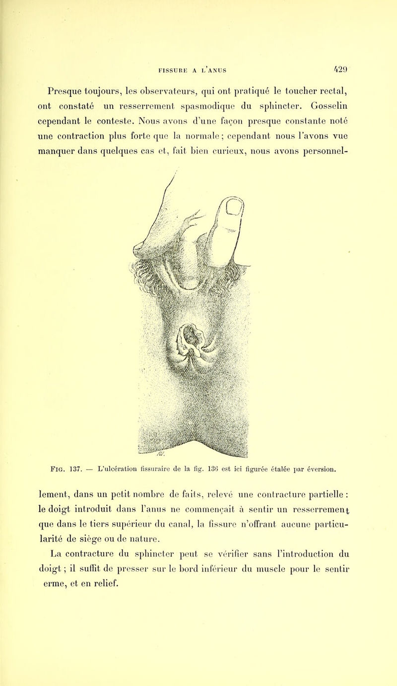 Presque toujours, les observateurs, qui ont pratiqué le toucher rectal, ont constaté un resserrement spasmodique du sphincter. Gosselin cependant le conteste. Nous avons d'une façon presque constante noté une contraction plus forte que la normale; cependant nous l'avons vue manquer dans quelques cas et, fait bien curieux, nous avons personnel- FiG. 137. — L'ulcération fissuraire de la fig. 13(5 est ici figurée étalée par éversion. lement, dans un petit nombre de faits, relevé une contracture partielle : le doigt introduit dans l'anus ne commençait à sentir un resserrement que dans le tiers supérieur du canal, la fissure n'offrant aucune particu- larité de siège ou de nature. La contracture du sphincter peut se vérifier sans l'introduction du doigt ; il suffit de presser sur le bord inférieur du muscle pour le sentir erme, et en relief.