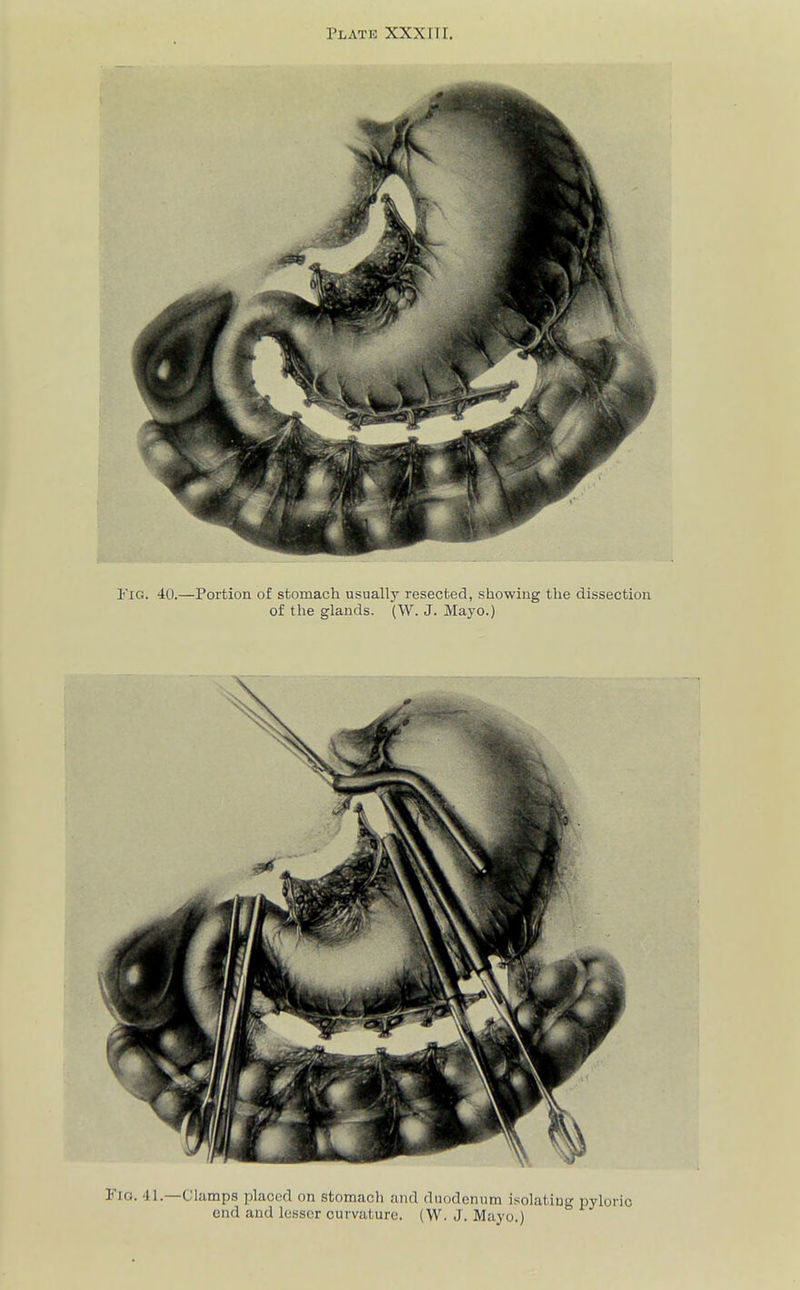 Flo. 41.—Clamps placed on stomach and duodenum isolating pyloric end and lesser curvature. (W. J. Mayo.)