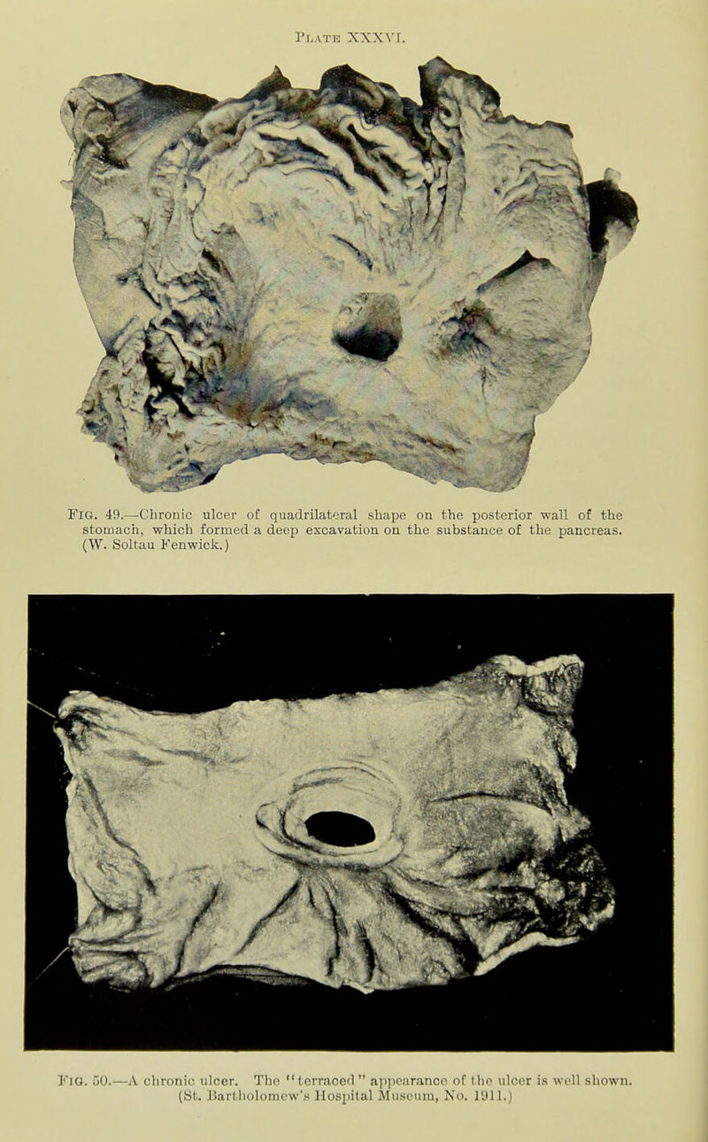 I Pl.ATJS XXXV I. Fig. 40.—Chronic ulcer of quadrilateral shape ou the posterior wall of the stomach, which formed a deep excavation on the substance of the pancreas. (W. Soltau Fenwick.) Fig. 50.—A chronic ulcer. The  terraced  ap])caranco of tho ulcer is well shown. (St. Bartholomew'.'; Hospital Museum, No. lUll.)