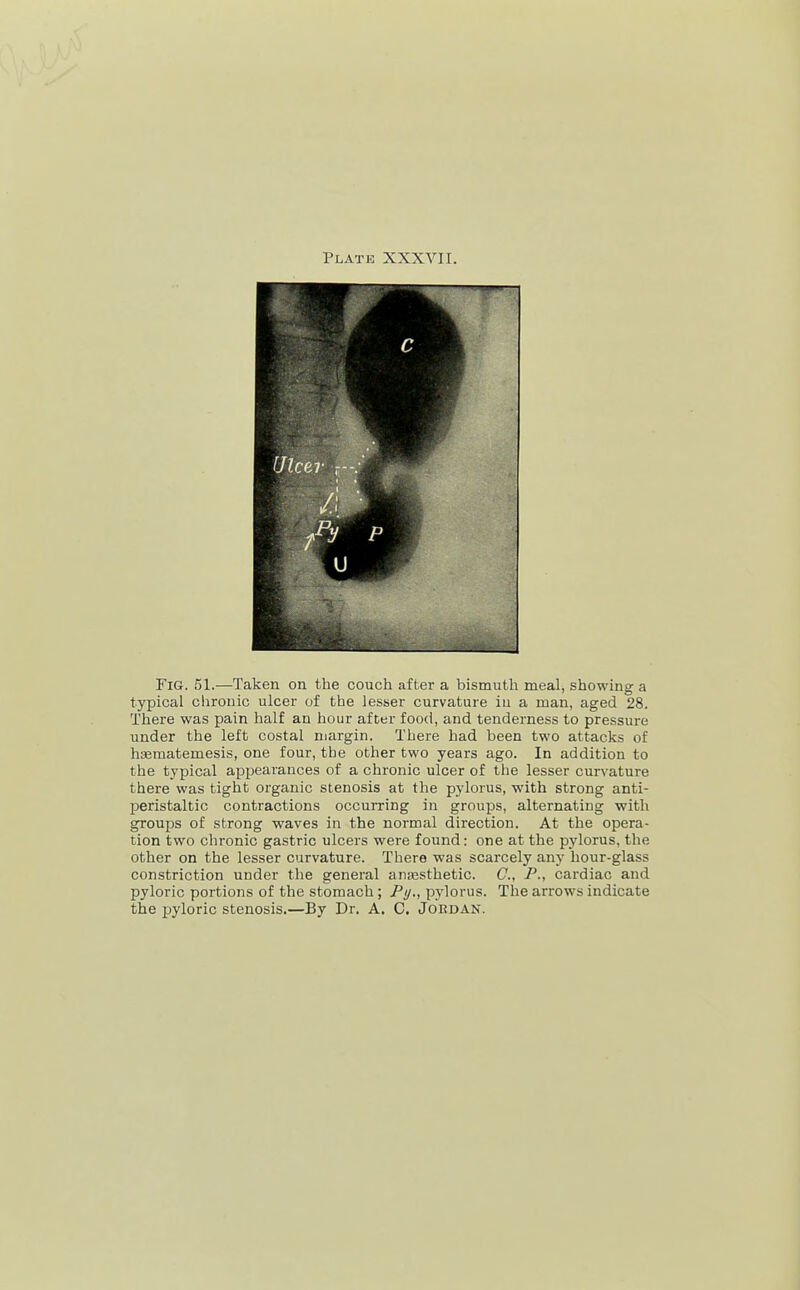 Plate XXXVII. Fig. 51.—Taken on the couch after a bismuth meal, showing a typical chronic ulcer of the lesser curvature iu a man, aged 28. There was pain half an hour after food, and tenderness to pressure under the left costal margin. There had been two attacks of haematemesis, one four, the other two years ago. In addition to the typical ajJijearances of a chronic ulcer of the lesser curvature there was tight organic stenosis at the pylorus, with strong anti- peristaltic contractions occurring in groups, alternating with groups of strong waves in the normal direction. At the opera- tion two chronic gastric ulcers were found: one at the pylorus, the other on the lesser curvature. There was scarcely any hour-glass constriction under the general anassthetic. C, P., cardiac and pyloric portions of the stomach ; Py., pylorus. The arrows indicate the pyloric stenosis.—By Dr. A. C. Jordan.