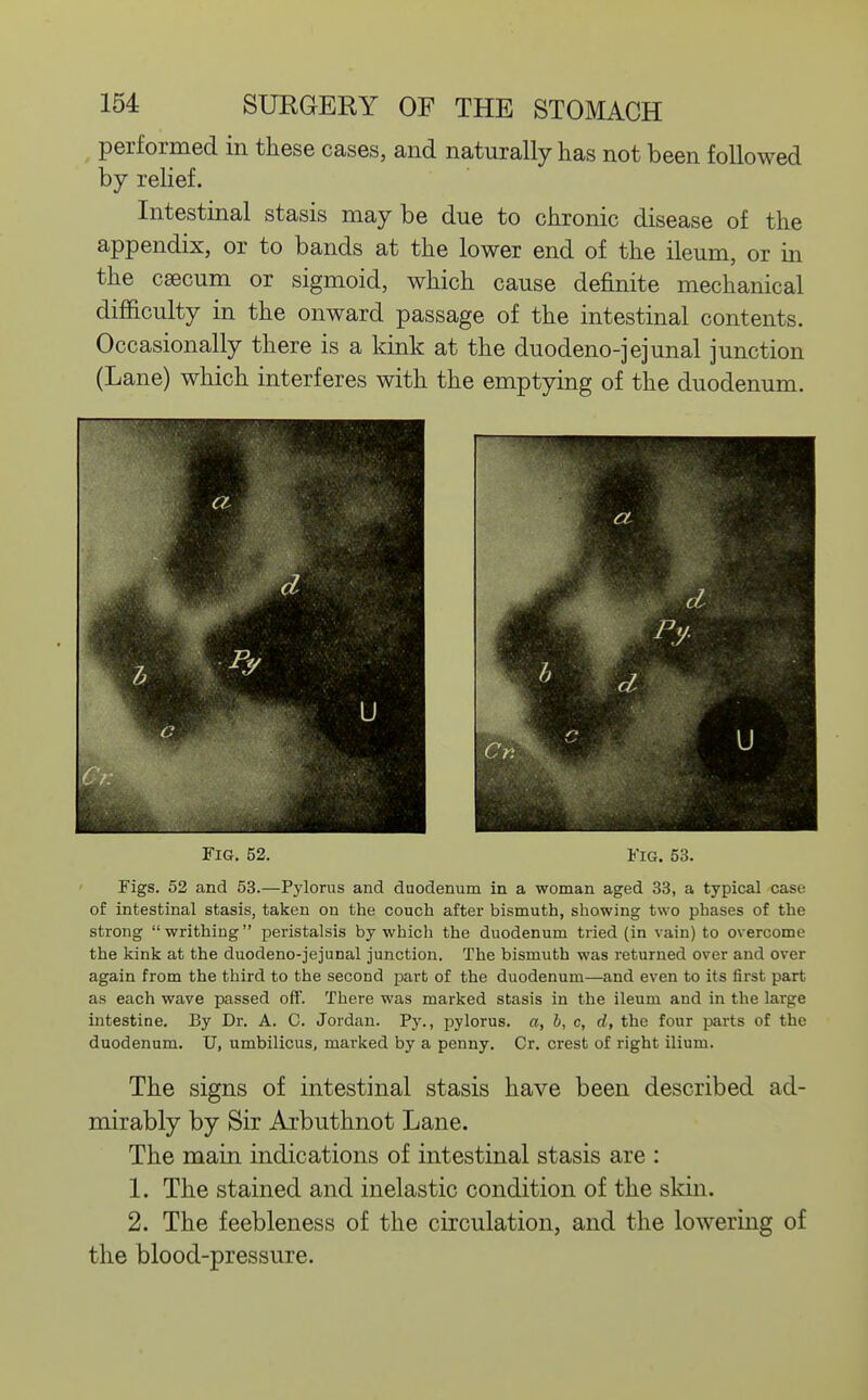 performed in these cases, and naturally has not been followed by relief. Intestinal stasis maybe due to chronic disease of the appendix, or to bands at the lower end of the ileum, or in the caecum or sigmoid, which cause definite mechanical difficulty in the onward passage of the intestinal contents. Occasionally there is a kink at the duodeno-jejunal junction (Lane) which interferes with the emptying of the duodenum. Fig. 52. Fig. 53. Figs. 52 and 53.—Pylorus and duodenum in a woman aged 33, a typical case of intestinal stasis, taken on the couch after bismuth, showing two phases of the strong  writhing peristalsis by which the duodenum tried (in vain) to overcome the kink at the duodeno-jejunal junction. The bismuth was returned over and over again from the third to the second part of the duodenum—and even to its first part as each wave passed off. There was marked stasis in the ileum and in the large intestine. By Dr. A. C. Jordan. Py., pylorus, a, b, c, d, the four jmi-ts of the duodenum. U, umbilicus, marked by a penny. Cr. crest of right ilium. The signs of intestinal stasis have been described ad- mirably by Sir Arbuthnot Lane. The main indications of intestinal stasis are : 1. The stained and inelastic condition of the skin. 2. The feebleness of the circulation, and the lowering of the blood-pressure.