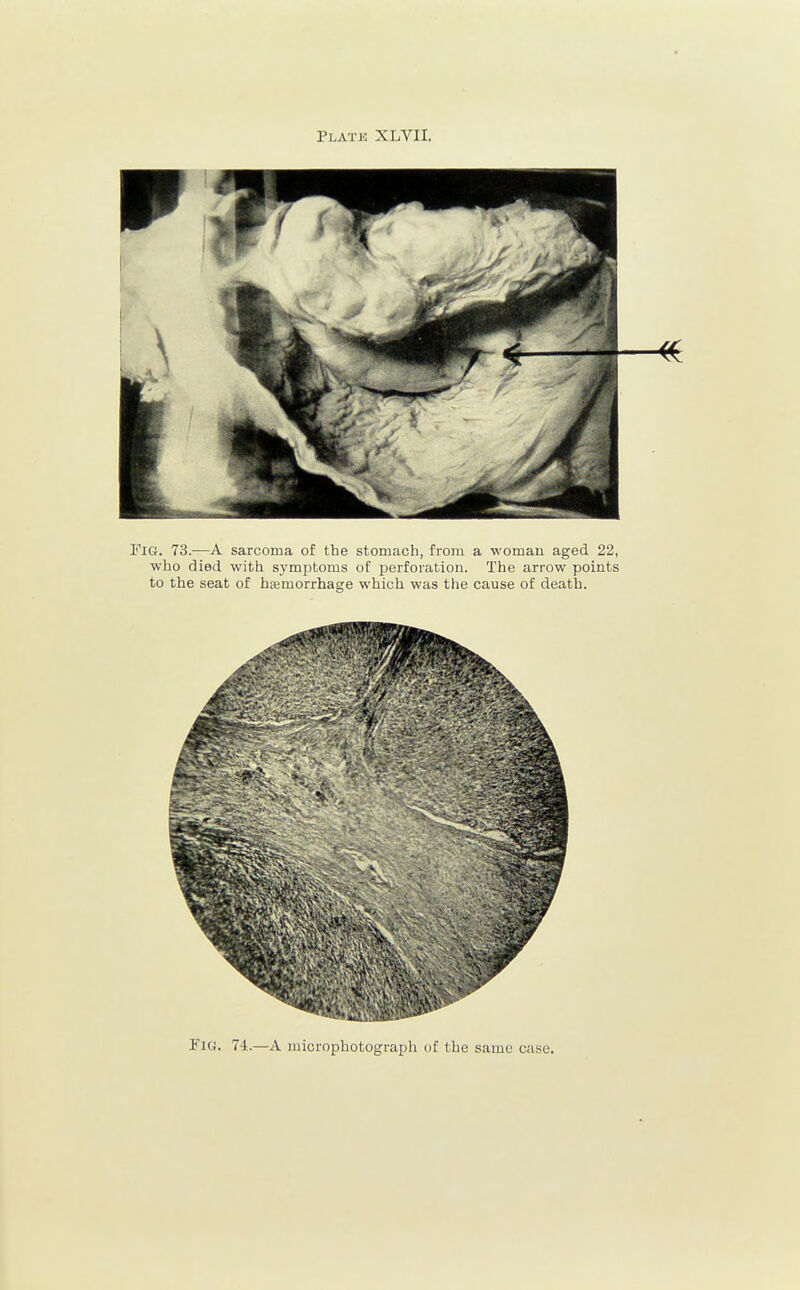 Plate XLVII. Fig. 73.—A sarcoma of the stomach, from a woman aged 22, who died with symptoms of perforation. The arrow points to the seat of htemorrhage which was the cause of death. Fig. 74.—A microphotograph of the same case.