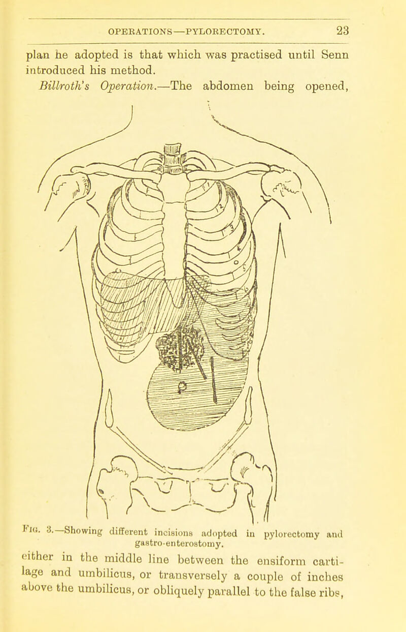 plan he adopted is that which was practised until Senn introduced his method. Billroth's Operation.—The abdomen being opened, Fig. 3.—Showing diflerent incisions adopted in pylorectomy and gastro-enterostoiny. either in the middle line between the ensiform carti- lage and umbilicus, or transversely a couple of inches above the umbilicus, or obliquely parallel to the false ribs,