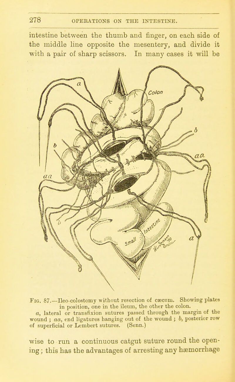 intestine between the thumb and finger, on each side of the middle hne opposite the mesentery, and divide it with a pair of sharp scissors. In many cases it will be Fig. 87.—Ileo-colostomy w ithout resection of caecum. Showing plates in position, one in the ileum, the other the colon. a, lateral or transfixion sutures passed through the margin of the wound ; aa, end ligatures hanging out of the wound ; b, posterior row of superficial or Lembert sutures. (Senn.) wise to run a continuous catgut suture round the open- ing ; this has the advantages of arresting any haemorrhage