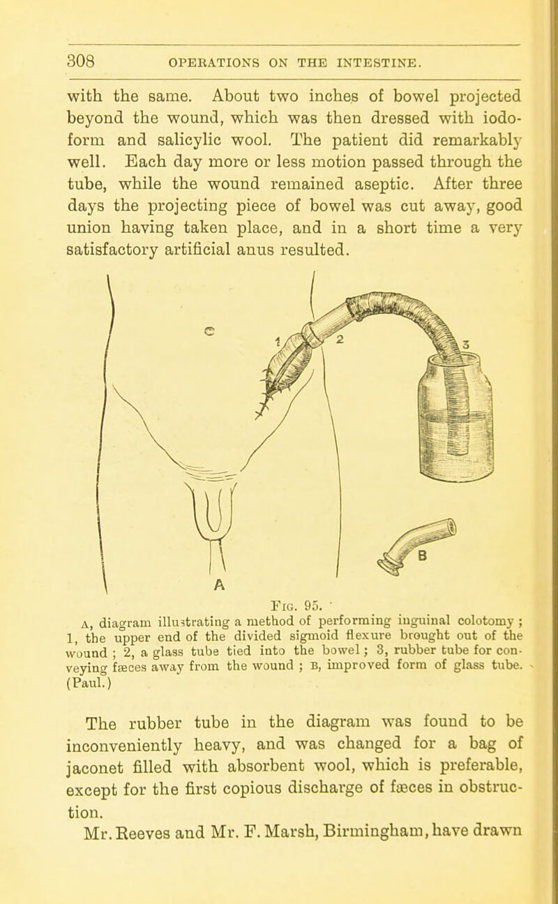 with the same. About two inches of bowel projected beyond the wound, which was then dressed with iodo- form and salicyUc wool. The patient did remarkablj- well. Each day more or less motion passed through the tube, while the wound remained aseptic. After three days the projecting piece of bowel was cut away, good union having taken place, and in a short time a very satisfactory artificial anus resulted. Fig. 95. ' A, diagram illustrating a method of performing inguinal colotomy ; 1, the upper end of the divided sigmoid flexure brought out of the wound ; 2, a glass tube tied into the bowel; 3, rubber tube for con- veying fseces away from the wound ; B, improved form of glass tube. (Paul.) The rubber tube in the diagram was found to be inconveniently heavy, and was changed for a bag of jaconet filled with absorbent wool, which is preferable, except for the first copious discharge of faeces in obstruc- tion. Mr. Reeves and Mr. F. Marsh, Birmingham, have drawn
