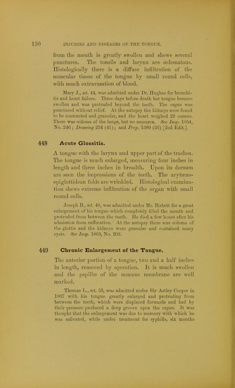 from the month is greatly swollen and shews several punctures. The tonsils and larynx are oedematous. Histologically there is a diffuse infiltration of the muscular tissue of the tongue by small round cells, with much extravasation of blood. Mary J., set. 44, was admitted under Dr. Hughes for bronchi- tis and heart failure. Three dnys before death her tongue became swollen aiul was protruded bej'ond the teeth. The organ wa.s punctured without relief. At the autopsy the kidneys were found to be contracted and granular, and the heart weighed 22 ounces. There was cedema of the lungs, but no anasarca. See Imj). 1854, No. 246 ; Brmoing 224 (41); and Pre;;. 1389 (25) [2nd Edit.]. i^cute Glossitis. A tongue with the larynx and upper part of the trachea. The tongue is much enlarged, measuring four inches in length and three inches in breadth. Upon its dorsum are seen the impressions of the teeth. The arytasno- epiglottidean folds are wrinkled. Histological examina- tion shews extreme infiltration of the organ with small round cells. Joseph B., a3t. 48, was admitted under Mr. Birkett for a great enlargement of Ids tongue which completely filled the mouth and protruded from between the teeth. He died a few hours after his admission from suffocation. At the autopsy there was oedema of tlie glottis and the kidneys were granular and contained many cysts. See Insp. 1863, No. 203. Chronic Enlargement of the Tongue. The anterior portion of a tongue, two and a half inches in length, removed by operation. It is much swollen and the papillre of the mucous membrane are well marked. Thomas L., v&t. 53, was admitted under Sir Astley Cooper in 1807 with his tongue greatly enlai-ged and protruding from between the teeth, which were displaced forwards and had by their pressure produced a deep groove upon the organ. It was thought that the enlargement was due to mercury with which lie was salivated, while under treatment for syphilis, si.\ months