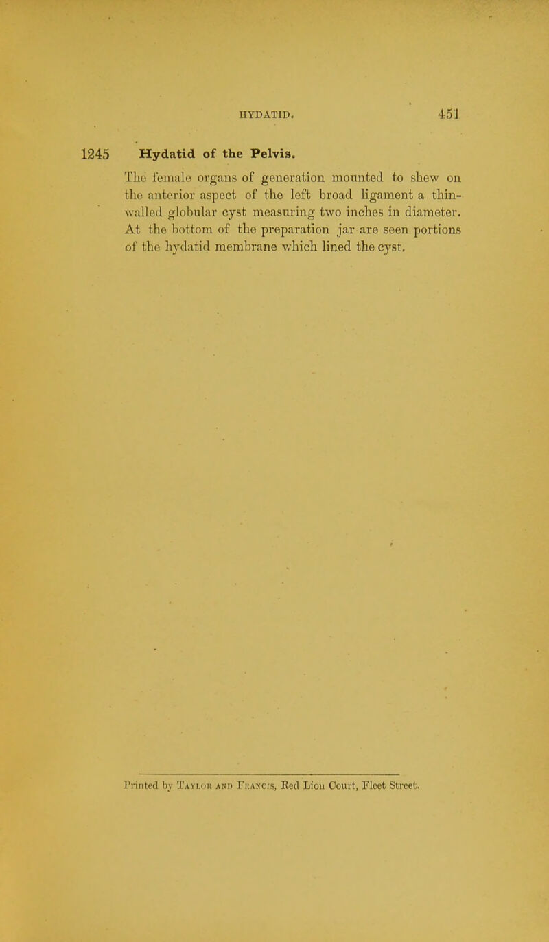1245 Hydatid of the Pelvis. The female organs of generation mounted to sliew on the anterior aspect of the left broad ligament a thiu- walled globular cyst measuring two inches in diameter. At the bottom of the preparation jar are seen portions of the hydatid membrane which lined the cyst. Printed by Tavlok and Frakcis, Eed Liou Court, Fleet Street.
