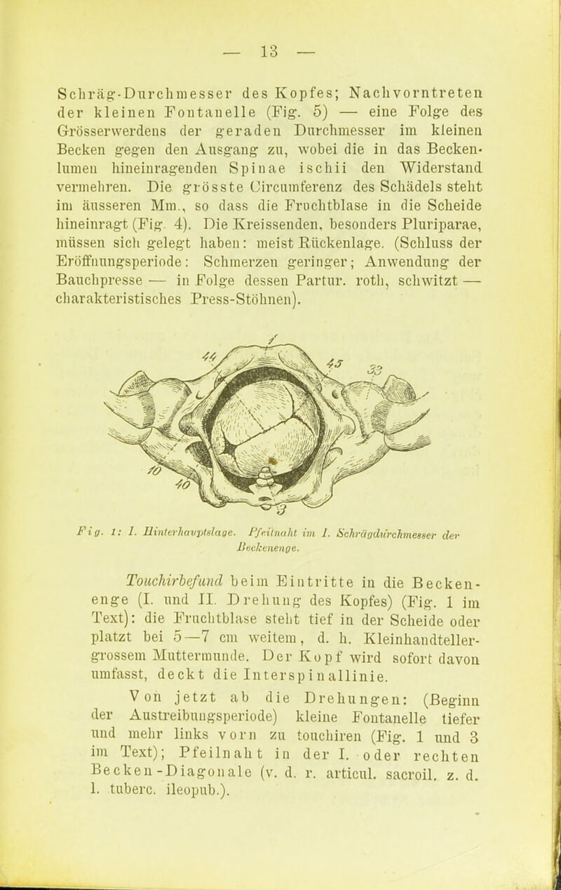 Schräg-Durchniesser des Kopfes; Nach vorntreten der kleinen Fontanelle (Fig. 5) — eine Folge des Grösserwerdens der geraden Durchmesser im kleinen Becken gegen den Ausgang zu, wobei die in das Becken- lumen hineinragenden Spinae ischii den Widerstand vermehren. Die grösste Circumferenz des Schädels steht im äusseren Mm., so dass die Fruchtblase in die Scheide hineinragt (Fig. 4). Die Kreissenden, besonders Pluriparae, müssen sich gelegt haben: meist Rückenlage. (Schluss der Eröifnungsperiode: Schmerzen geringer; Anwendung der Bauchpresse — in Folge dessen Partur. roth, schwitzt — charakteristisches Press-Stöhnen). Fig. I: 1. lUnteihavjitulage. F/e.iinaht im 1. üchrägdurchmeaaer dev Jiec/cenenge. Toiichirbefuncl beim Eintritte in die Becken- enge (I. und II. Drehung des Kopfes) (Fig. 1 im Text): die Fruchtblase steht tief in der Scheide oder platzt bei 5—7 cm weitem, d. h. Kleinhandteller- grossem Muttermunde. Der Kopf wird sofort davon umfasst, deckt die Interspi nallinie. Von jetzt ab die Drehungen: (Beginn der Austreibuugsperiode) kleine Fontanelle tiefer und mehr links vorn zu touchiren (Fig. 1 und 3 im Text); P fei ln ah t in der I. oder rechten Becken-Diagonale (v. d. r. articul. sacroil. z. d. 1. tuberc. ileopub.).