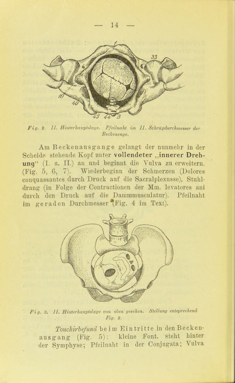 Fig. 2. II. Hinterhauptnlage. Pfeilnaht im 11. Schrägdurchmesaer der Beckenenge. Am Beckenausgange gelangt der nunmelir in der Scheide stehende Kopf unter vollendeter „innerer Dreh- ung“ (I. u. TI.) an lind beginnt die Vulva zu erweitern. (Fig. 5, G, 7). AViederbeginn der Schmerzen (Doloi’es conquassantes durch Druck auf die Sacralplexusse), Stuhl- drang (in Folge der Contractionen der Mm. levatores aiii durch den Druck auf die Dammrausculatur). Pfeilnaht im geraden Durchmesser*(Fig. 4 im Text). Fi g. 3. II. Hinterhavptalage von oben gesehen. Stellung entsprechend Fig. 2. Touchirbefunä beim Eintritte in denBeckeu- ausgang (Fig. 5): kleine Font, steht hinter der Symphyse; Pfeilnalit in der Conjugata; Aulva