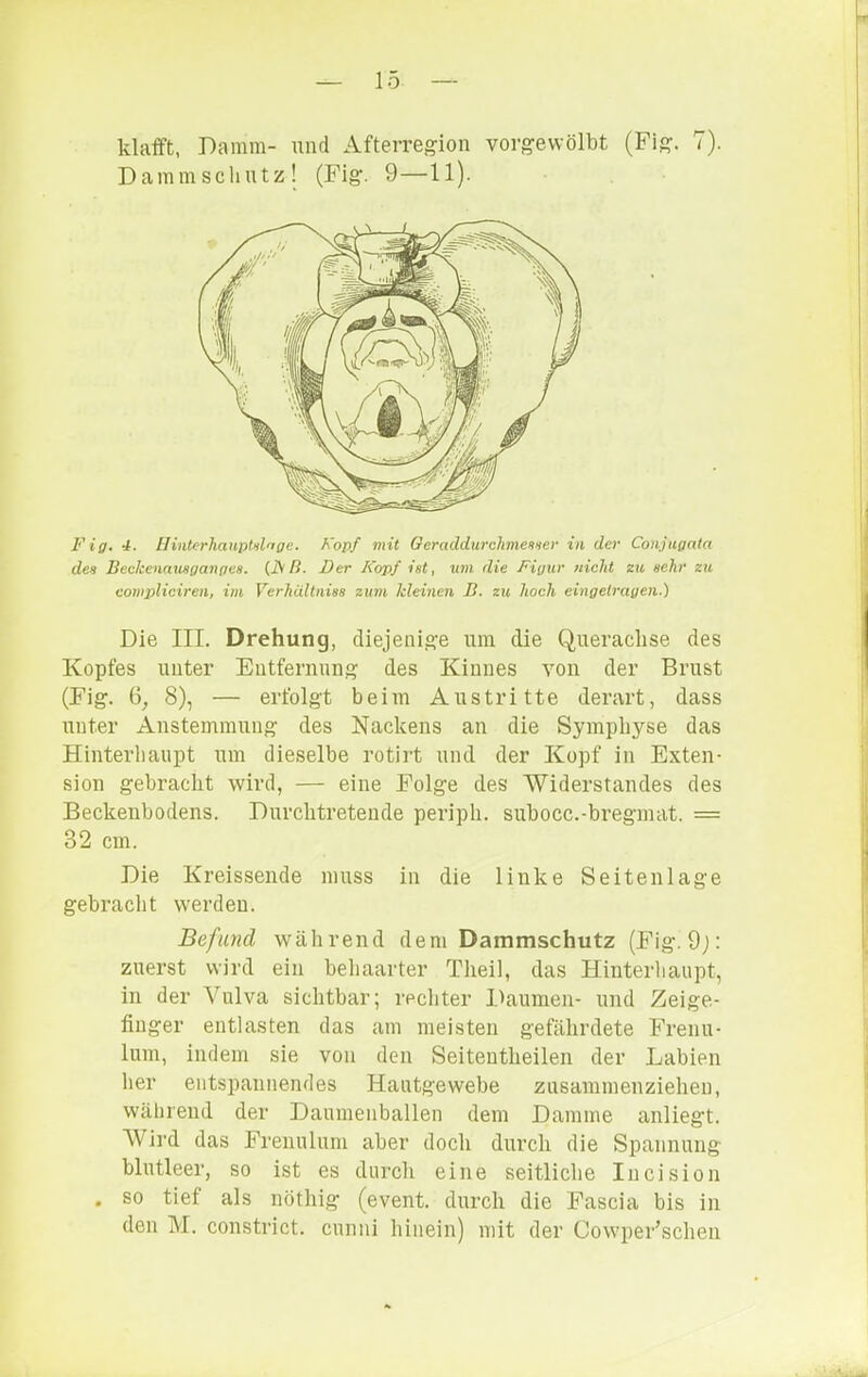 klafft, Damm- und Afterregion vorgewölbt (Fig. 7). Dammsclintz! (Fig. 9—11). Fig. 4. Hinterhanpldrige. Kopf mit Geraddurclimenier in der Conjugata des Beekenausgangea. (JSB. Der Kopf ist, um die Figur nicht zu sehr zu compliciren, im Verhültnias zum kleiiien B. zu hoch, eingetragen.) Die III. Drehung, diejenige nm die Querachse des Kopfes unter Entfernung des Kinnes von der Brust (Fig. 6, 8), — erfolgt beim Austritte derart, dass unter Anstemmung des Nackens an die Symphyse das Hinterhaupt um dieselbe rotirt und der Kopf in Exten- sion gebracht wird, — eine Folge des Widerstandes des Beckeubodens. Durchtretende periph. subocc.-bregmat. = 32 cm. Die Kreissende muss in die linke Seitenlage gebracht werden. Befand während dem Daramschutz (Fig. 9j: zuerst wird ein behaarter Theil, das Hinterliaupt, in der Vulva sichtbar; rechter Ihaumen- und Zeige- finger entlasten das am meisten gefährdete Frenu- lum, indem sie von den Seitentheilen der Labien her entspannendes Hautgewebe zusammeuzieheu, während der Daumenballen dem Damme anliegt. AVird das Frenulum aber doch durch die Spannung blutleer, so ist es durch eine seitliche Incision . so tief als nöthig (event. durch die Fascia bis in den M. constrict. cunni hinein) mit der CowpeFschen