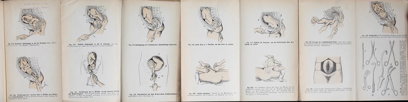 „Ein- Fia 113. Direkter Uebergang in die lU. Position beim ?: h D e i d e D “ des Kopfes: Pammscbotz. schm ttranioklasten in den pcrfonrten Schadol unter J>jituDg der toacürendcn linken Hand. Fig. 116. Dann Zug in I Position, um das Kinn zu senken. Fig. 117. Endlich 111. Position, um das Hinterhaupt über den Damm zu ziehen. Fig. 118. Forceps bei nachfolgendem Kopfe, uutor box.\v. hiutor dom kiudlicbou Rumpfo angelegt; lotztoror gogon dio miilfürliohon Bnuclideckou gohobou; Dammschiitz. Fia 121 Einführuno des II. Blattes an die äussere Fläelie des Hinterhauptes. Dm Flügelschrauhe presst be.de ^.no an- sanimen, so dass der Schädel zormnlmt, vorkloinovl and /uv Extraction fest gefasst wird. Fig 123. Sectio caesarea. Schuitt in der Medianlinie; Fig 124. Dev Operateur drängt den Steiss des. Kindes aus der Oobäniiuttor heraus uud bebt mit der Rechten den Kopf des Rindes von dom Bcckoiieingaiig her. Der Assistent hält die der Wundwinkel der Gebärmutter auseinander uud die Bauchdcckon ih Fig 125. Tiefgioifoudo soro-musculiiio Nähte; oboilliichliobo soio-seröso Nähto, ralzou dio roritonoiil-Wuiidniiidor ein nach Art der Lonibort’scheu Dariiuiabt. Flxlren der Porilo va^nnlls