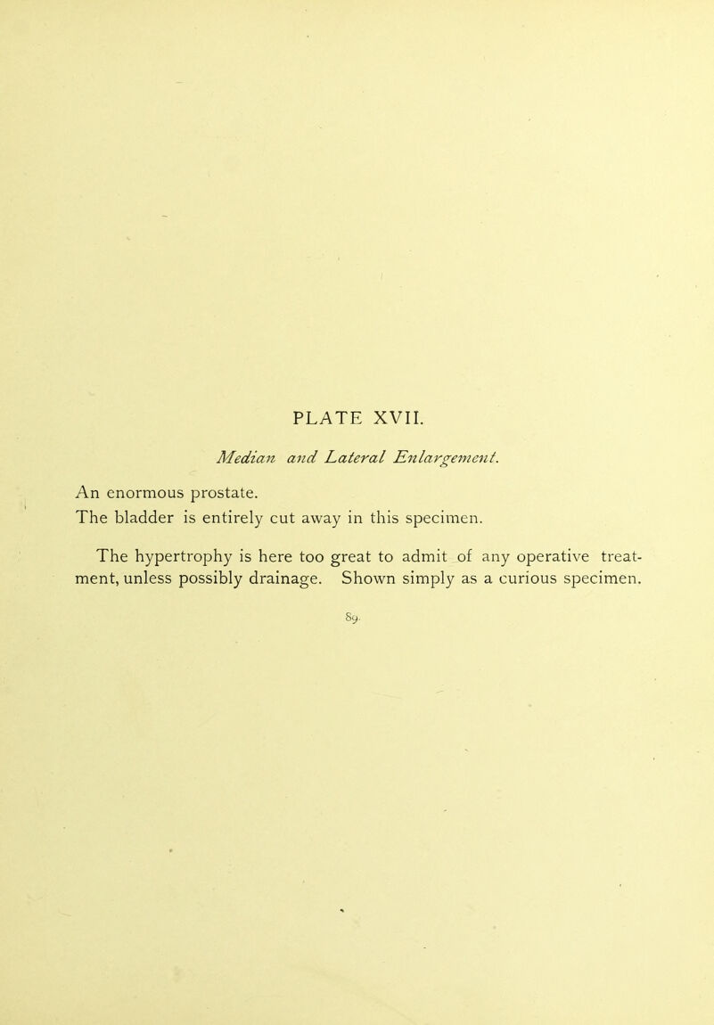 Median and Lateral Enlargement. An enormous prostate. The bladder is entirely cut away in this specimen. The hypertrophy is here too great to admit of any operative treat- ment, unless possibly drainage. Shown simply as a curious specimen. s9.