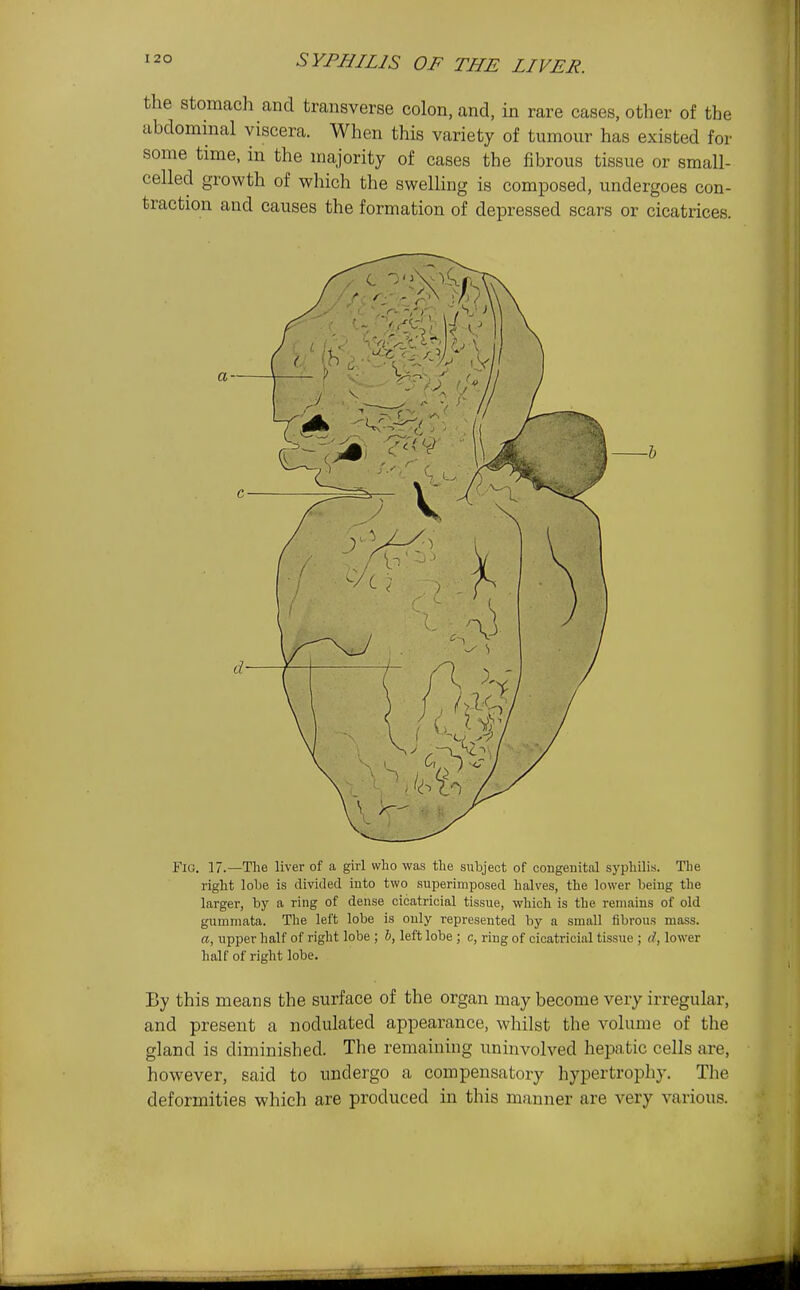 the stomach and transverse colon, and, in rare cases, other of the abdominal viscera. When this variety of tumour has existed for some time, in the majority of cases the fibrous tissue or small- celled growth of which the swelling is composed, undergoes con- traction and causes the formation of depressed scars or cicatrices. a Fig. 17.—The liver of a girl who was the subject of congeuitnl syphilis. The right lohe is divided into two superimposed halves, the lower being the larger, by a ring of dense cicatricial tissue, which is the remains of old gummata. The left lobe is only represented by a small fibrous mass. a, upper half of right lobe ; h, left lobe; c, ring of cicatricial tissue ; d, lower half of right lobe. By this means the surface of the organ may become very irregular, and present a nodulated appearance, whilst the volume of the gland is diminished. The remaining uninvolved hepatic cells are, however, said to undergo a compensatory hypertrophy. The deformities which are produced in this manner are very various.